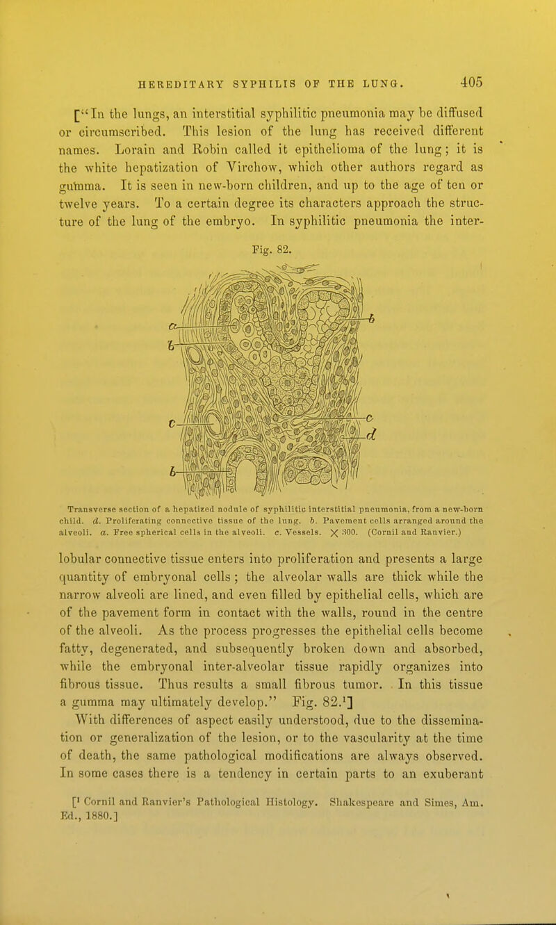 [In the lungs, an interstitial syphilitic pneumonia may be diffused or circumscribed. This lesion of the lung has received different names. Lorain and Robin called it epithelioma of the lung; it is the white hepatization of Virchow, which other authors regard as gutama. It is seen in new-boi'n children, and up to the age of ten or twelve years. To a certain degree its characters approach the struc- ture of the lung of the embryo. In syphilitic pneumonia the inter- Pig. 82. Transverse section of a hepatized nodule of syphilitic interstitial pneumonia, from a new-born child, d. Proliferating connective tissue of the lung. b. Pavement cells arranged around the alveoli, a. Free spherical cells in the alveoli, c. Vessels. X (Coruil and Ranvier.) lobular connective tissue enters into proliferation and presents a large quantity of embryonal cells ; the alveolar walls are thick while the narrow alveoli are lined, and even filled by epithelial cells, which are of the pavement form in contact with the walls, round in the centre of the alveoli. As the process progresses the epithelial cells become fatty, degenerated, and subsequently broken down and absorbed, while the embryonal inter-alveolar tissue rapidly organizes into fibrous tissue. Thus results a small fibrous tumor. In this tissue a gumma may ultimately develop. Fig. 82.'] With differences of aspect easily understood, due to the dissemina- tion or generalization of the lesion, or to the vascularity at the time of death, the same pathological modifications are always observed. In some cases there is a tendency in certain parts to an exuberant [' Cornil and Ranvier's Pathological Histology. Sliakespeare and Simes, Am. Ed., 1880.]