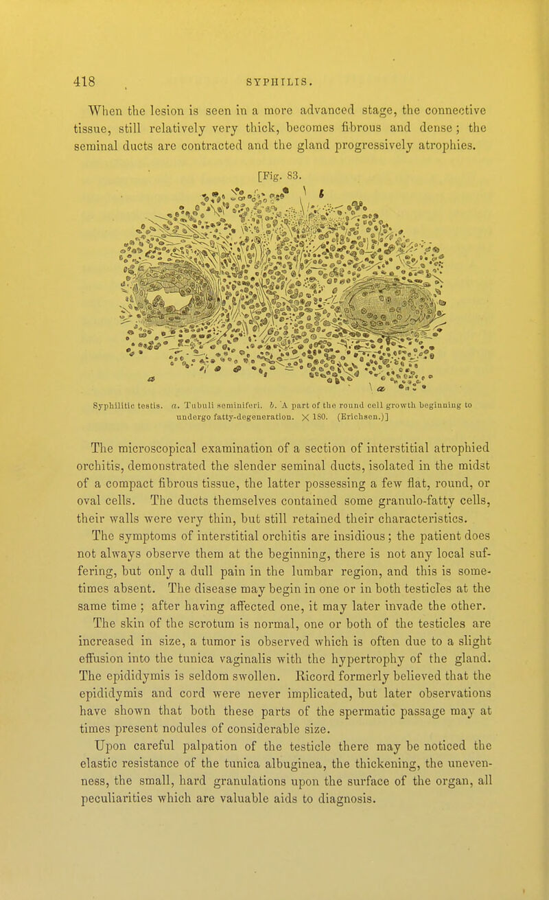 When the lesion is seen in a more advanced stage, the connective tissue, still relatively very thick, becomes fibrous and dense; the seminal ducts are contracted and the gland progressively atrophies. [Fig. 83. Syphilitic testis, a. Tiibuli aeniiuifui'i. b. A part of the round cell growth hegiuaiug to undergo fatty-degenoration. X ISO. (Erichsen.)] The microscopical examination of a section of interstitial atrophied orchitis, demonstrated the slender seminal ducts, isolated in the midst of a compact fibrous tissue, the latter possessing a few flat, round, or oval cells. The ducts themselves contained some granulo-fatty cells, their walls were very thin, but still retained their characteristics. The symptoms of interstitial orchitis are insidious; the patient does not always observe them at the beginning, there is not any local suf- fering, but only a dull pain in the lumbar region, and this is some- times absent. The disease may begin in one or in both testicles at the same time ; after having affected one, it may later invade the other. The skin of the scrotum is normal, one or both of the testicles are increased in size, a tumor is observed which is often due to a slight elfusion into the tunica vaginalis with the hypertrophy of the gland. The epididymis is seldom swollen. Ricord formerly believed that the epididymis and cord were never implicated, but later observations have shown that both these parts of the spermatic passage may at times present nodules of considerable size. Upon careful palpation of the testicle there may be noticed the elastic resistance of the tunica albuginea, the thickening, the uneven- ness, the small, hard granulations upon the surface of the organ, all peculiarities which are valuable aids to diagnosis.