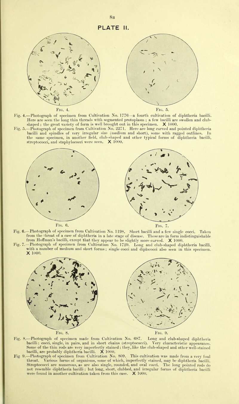 8b PLATE II. Tig. 4. Pig. 4.—Photograph of specimen from Cultivation No. 1776—a fourth cultivation of diphtheria bacilli. Here are seen the long thin threads with segmented protoplasm ; a few bacilli are swollen and clul> shaped ; the great variety of form is well brought out in this specimen. X 1000. 5,—Photograph of specimen from Cultivation jN'o. 2271. Here are long curved and pointed diphtheria bacilli and spindles of very irregular size (medium and short), some with ragged outlines. In the same specimen, in another field, club-shaped and other typical forms of diphtheria bacilli, streptococci, and staphylococci were seen. X 1000. Pig. Pig. 7. Pig. 6.—Photograph of specimen from Cultivation jVo. 1198. Short bacilli and a few single cocci. Taken from the throat of a case of diphtheria in a late stage of disease. These are in form indistinguishable from Hoffman's bacilli, except that they appear to be slisjhtly more curved. X 1000. Pig. 7.—Photograph of specimen from Cultivation No. 1729.' Long and club-shaped diphtheria bacilli, with a number of medium and short forms; single cocci and diplococci also seen in this specimen. X 1000. Pig. 8 Pi? —Photograph of specimen made from Cultivation No. 687. Long and club-shaped diphtheria bacilli; cocci, single, in pairs, and in short chains (streptococci). A'ery characteristic appearance. Some of the thin rods are very imperfectly stained ; they, like the club-shaped and other well-stained bacilli, are probably diphtheria bacilli. X 1000. 9.—Photograph of specimen from Cultivation No. 809. This cultivation was made from a very foul throat. Various forms of organisms, some of which, imperfectly stained, may be diphtheria bacilli. Streptococci are numerous, as are also single, rounded, and oval cocci. The long pointed rods do not resemble diphtheria bacilli; but long, short, clubbed, and irregular forms of diphtheria bacilli were found in another cultivation taken from this case. X lOOO.