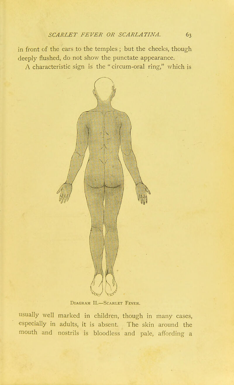 in front of the ears to the temples ; but the cheeks, though deeply flushed, do not show the punctate appearance. A characteristic sign is the  circum-oral ring, which is Diagram II.—Scarlet Fever. usually well marked in children, though in many cases, especially in adults, it is absent. The skin around the mouth and nostrils is bloodless and pale, affording a