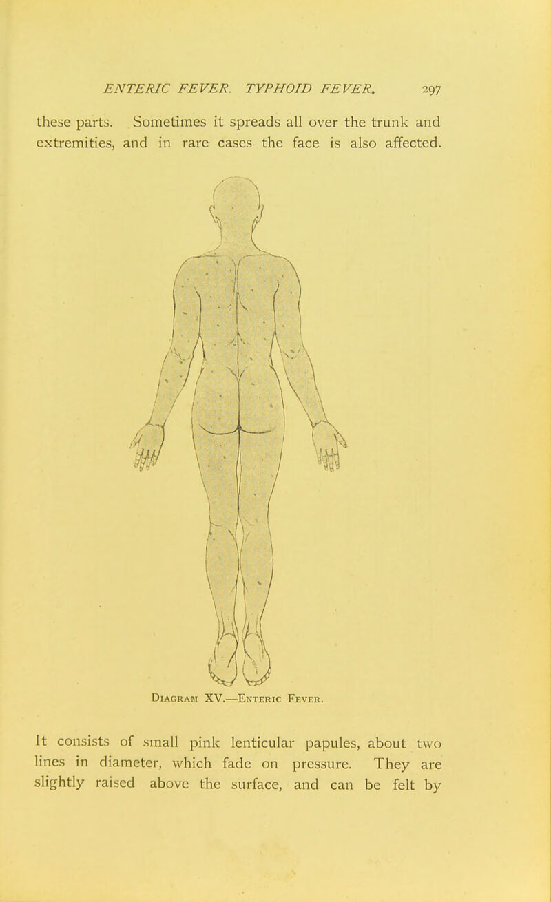 these parts. Sometimes it spreads all over the trunk and extremities, and in rare cases the face is also affected. Diagram XV.—Enteric Fever, It consists of small pink lenticular papules, about two lines in diameter, which fade on pressure. They are slightly raised above the surface, and can be felt by