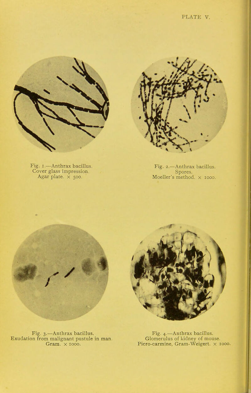 Fig. 3.—Anthrax bacillus. Exudation from malignant pustule in man. Gram, x looo. Fig. 4.—Anthrax bacillus. Glomerulus of kidney of mouse. Picro-carmine, Gram-Weigert. x 1000.