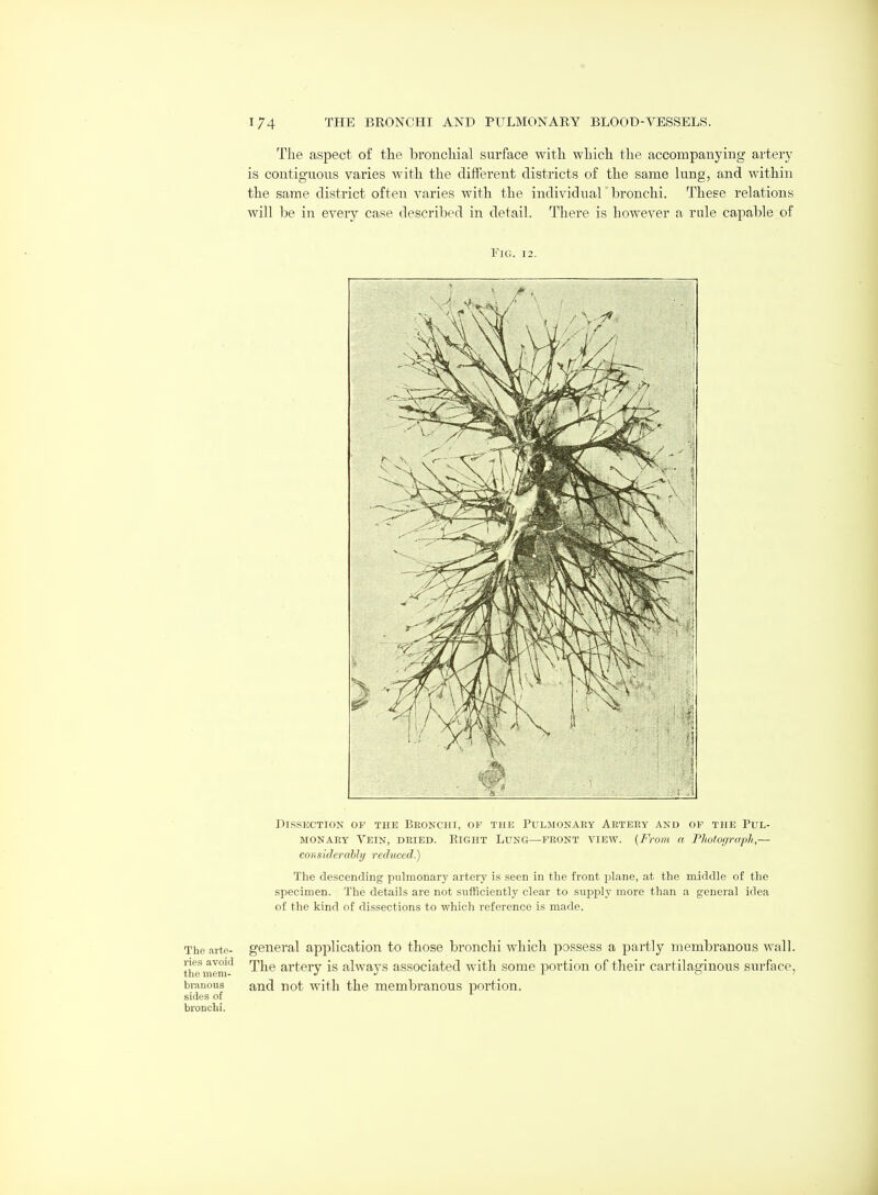 The aspect of the bronchial surface with which the accompanying artery is contiguous varies with the different districts of the same lung, and within the same district often varies with the individuaF bronchi. These relations will be in every case described in detail. There is however a rule capable of Fig. 12. Dissection of the Beonchi, op the Pulmonaey Aeteey and of the Pul- MONAEY Vein, deied. Right Lunc4—feont view. {From a Phoiot/rapli,— considerahly reduced.) The descending pulmonary artery is seen in the front plane, at the middle of the specimen. The details are not sufficiently clear to supply more than a general idea of the kind of dissections to which reference is made. The .arte- general application to those bronchi which possess a partly membranous wall, tlfemem'^ The artery is always associated with some portion of their cartilaginous surface, br.aiious and not with the membranous portion, sides of bronchi.