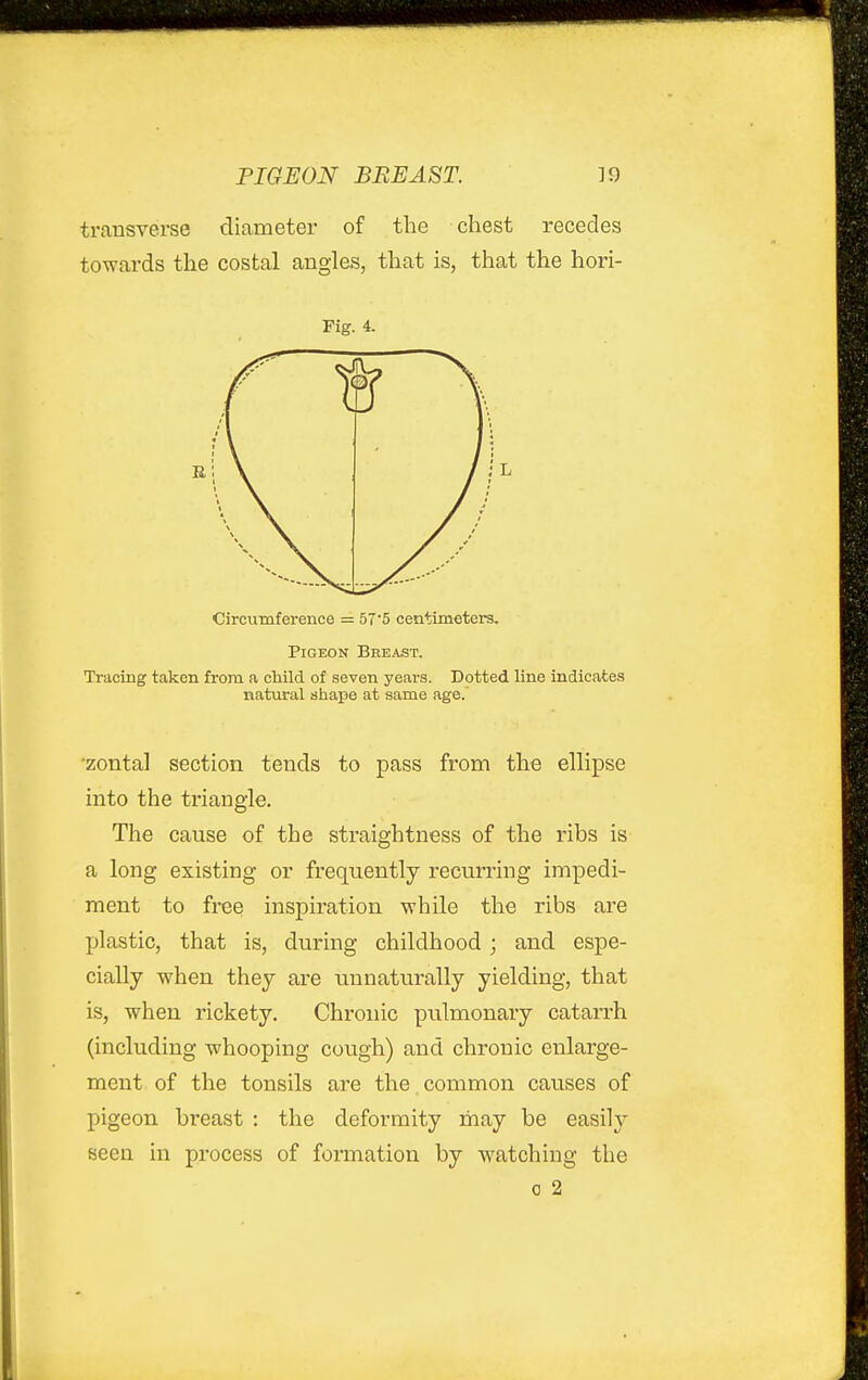 PIGEON BREAST. 39 transverse diameter of the chest recedes towards the costal angles, that is, that the hori- Fig. 4. Circumference = 57'5 centimeters. Pigeon Breast. Tracing taken from a child of seven years. Dotted line indicates natural shape at same age. •zontal section tends to pass from the ellipse into the triangle. The cause of the straightness of the ribs is a long existing or frequently recuri'ing impedi- ment to free inspiration while the ribs are jjlastic, that is, during childhood; and espe- cially when they are unnaturally yielding, that is, when rickety. Chronic pulmonary catarrh (including whooping cough) and chronic enlarge- ment of the tonsils are the common causes of pigeon breast : the deformity may be easily seen in process of formation by watching the 0 2