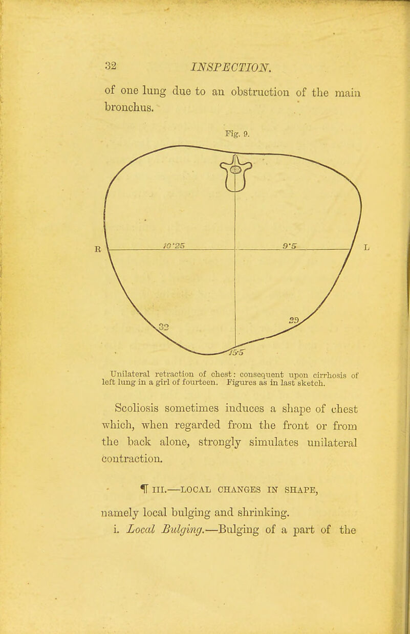 of one lung due to an obstruction of the main bronchus. Fig. 9. Unilateral retraction of chest: consequent upon cirrhosis of left lung in a girl of fourteen. Figures as in last sketch. Scoliosis sometimes induces a shape of chest which, when regarded from the front or from the back alone, strongly simulates unilateral contraction. IT III. LOCAL CHANGES IN SHAPE, namely local bulging and shrinking. i. Local Bulging.—Bulging of a part of the
