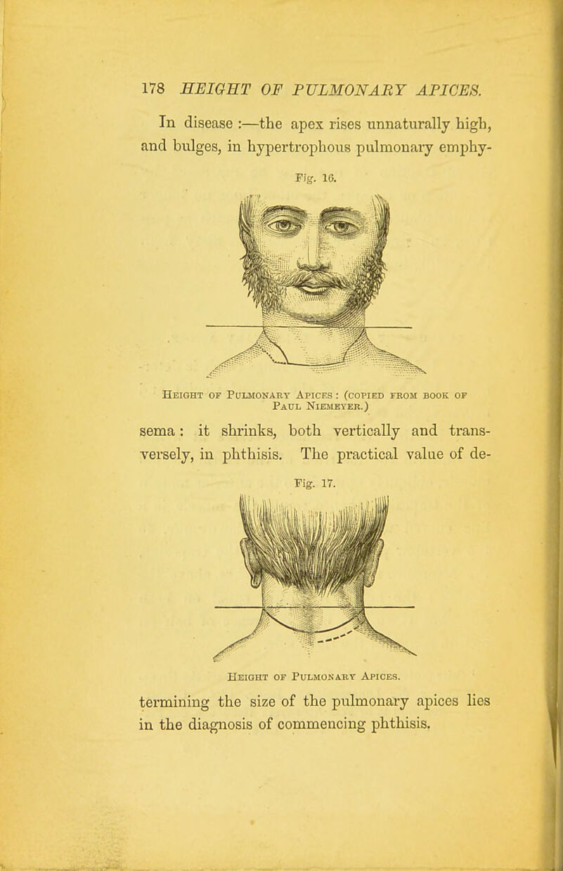 In disease :—the apex rises unnaturally high, and bulges, in hypertrophous pulmonary emphy- Fig. 10. Height of Pulmonary Apices : (copied from book of Paul Niemeyer.) sema: it shrinks, both vertically and trans- versely, in phthisis. The practical value of de- Fig. 17. Height of Pulmonary Apices. termining the size of the pulmonary aj)ices lies in the diagnosis of commencing phthisis.