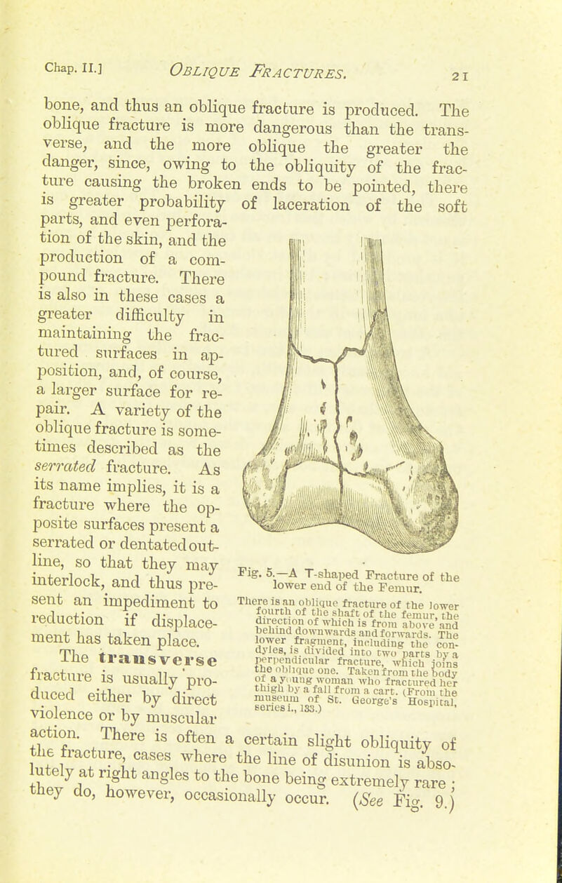 21 bone, and thus an oblique fracture is produced. The oblique fracture is more dangerous than the trans- verse, and the more oblique the greater the danger, since, owing to the obliquity of the frac- ture causing the broken ends to be jjointed, there IS greater probability of laceration of the soft parts, and even perfora- tion of the skin, and the production of a com- pound fracture. There is also in these cases a greater difficulty in maintaining the frac- tured surfaces in ap- position, and, of course, a larger surface for re- pair. A variety of the oblique fracture is some- times described as the serrated fracture. As its name implies, it is a fracture where the op- posite surfaces present a serrated or dentated out- line, so that they may interlock, and thus pre- sent an impediment to reduction if displace- ment has taken place. The transverse fracture is usually'pro- duced either by direct Pig. 5.—A T-shaped Fracture of the lower end of the Femur. There is .an oblique fracture of the lower fourch of tlie shaft of the femur, the hp'i^n'il°J' °^ from above'and pelund downwards and forwards. The lower fragment, in(;luding the con- dyles, is divided into two parts by a porpendicular fracture, which joins the nblKiuc one. Taken from the body of a young woman who fractured her thigh l)y a fall from a cart. (From the museum of St. George's Hospital series i., 133.) -nuw, violence or by muscular action. There is often a certain slight obliquity of the fracture cases where the line of disunion is abso- utely at right angles to the bone being extremely rare • they do, however, occasionally occur. {See Ficr 9 j