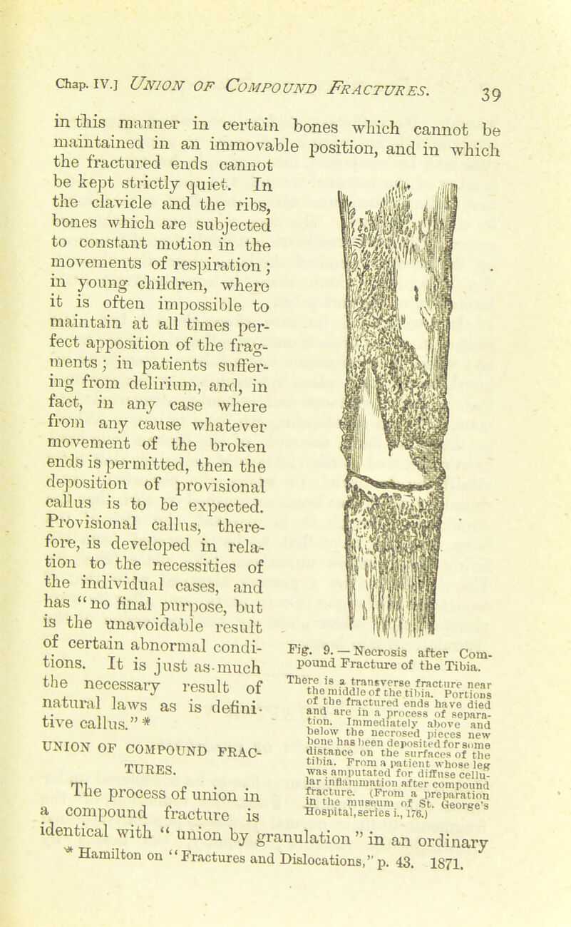 Chap. IV.] Union of Compound Fractures. in tliis manner in certain bones which cannot be manitained in an immovable position, and in which the fractured ends cannot be kept strictly quiet. In the clavicle and the ribs, bones which are subjected to constant motion in the movements of respiration; in young children, where it is often impossible to maintain at all times per- fect apposition of the frag- ments; in patients suffer- ing from delu-ium, and, in fact, in any case where from any cause whatever movement of the broken ends is permitted, then the deposition of provisional callus is to be expected. Provisional callus, there- fore, is developed in rela- tion ^ to the necessities of the individual cases, and has no final purpose, but is the unavoidable result of certain abnormal condi- tions. It is just as much the necessary result of natural laws as is defini- tive callus. * UNION OP COMPOUND FRAC- TURES. The process of union in a compound fractui-e is identical with  union by granulation  in an ordinary '* Hamilton on '' Fractures and Dislocations, p. 43. I871. rig'. 9.—Necrosis after Com- pound Fracture of the Tibia. There is a transverse fracture near the middle of the tibia. Portions ol the fractured ends have died and are in a process of separa- tion. Immediately ahove and pelow the necrosed pieces new hone ha8l)een depositedforsome distance on the surfaces of the tihia. From a patient whose lee was amputated for diffuse cellu- Jar inflammation after compound pacture. (From a preparation m the museum of St. Georee's Hospital, series i., 176.)