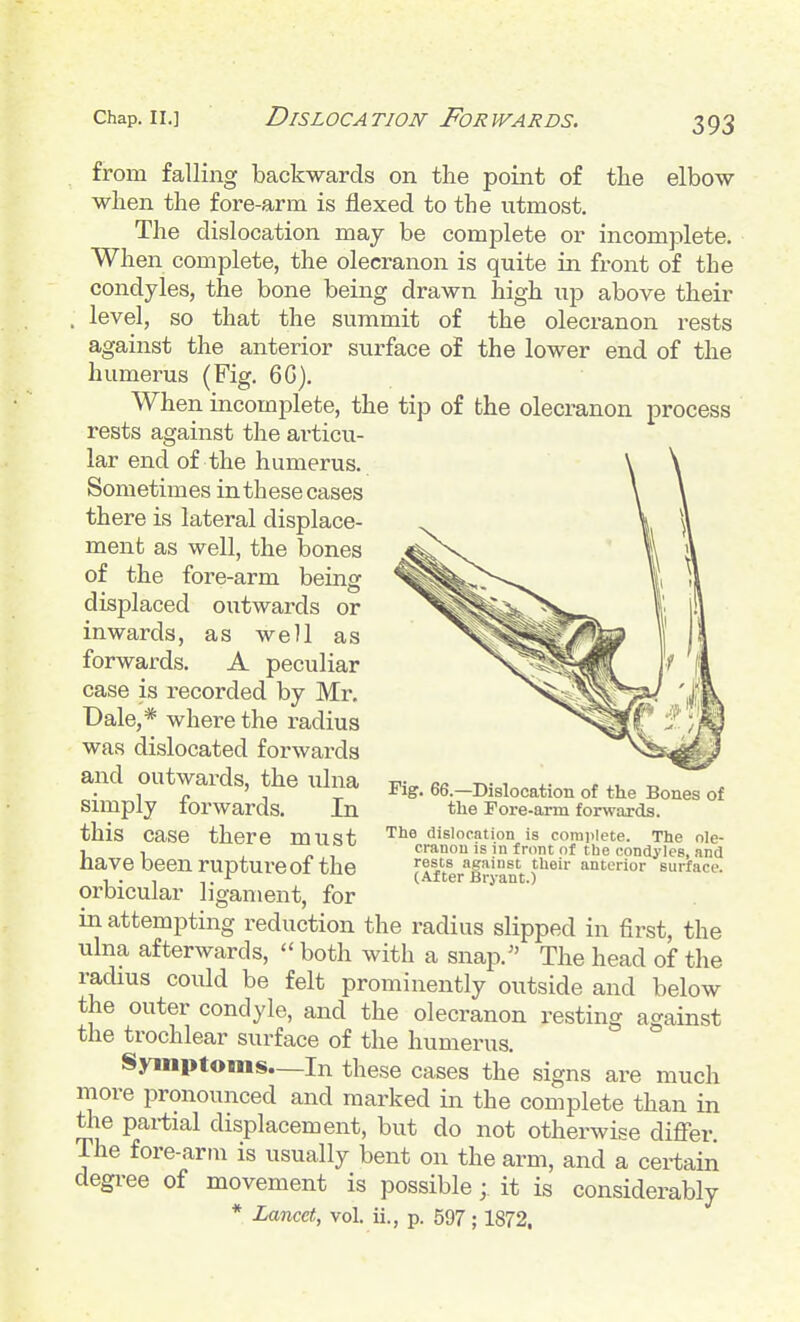 from falling backwards on the point of the elbow when the fore-arm is flexed to the utmost. The dislocation may be complete or incomplete. When complete, the olecranon is quite in front of the condyles, the bone being drawn high up above their . level, so that the summit of the olecranon rests against the anterior surface of the lower end of the humerus (Fig. 6G). When incomplete, the tip of the olecranon process rests against the articu- lar end of the humerus. Sometimes in these cases there is lateral displace- ment as well, the bones of the fore-arm being displaced outwards or inwards, as well as forwards. A peculiar case is recorded by Mr, Dale,* where the radius was dislocated forwards and outwards, the ulna simply forwards. In this case there must have been rupture of the orbicular ligament, for in attempting reduction the radius slipped in first, the ulna afterwards,  both with a snap.'' The head of the radius could be felt prominently outside and below the outer condyle, and the olecranon resting against the trochlear surface of the humerus. Symptoms—In these cases the signs are much more pronounced and marked in the complete than in the partial displacement, but do not otherwise differ The fore-arm is usually bent on the arm, and a certain degi-ee of movement is possible; it is considerably * Lancet, vol. ii., p. 597 ; 1872, Fig. 66.—Dislocation of the Bones of the Fore-arm forwards. The dislocation is complete. The ole- cranon is in front of the condyles, and rests against their anterior surface. (After Bryant.)