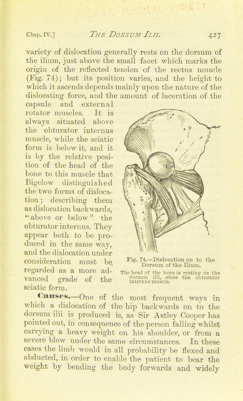 variety of dislocation generally rests on tlie dorsum of the ilium, just above the small facet which marks the origin of the reflected tendon of the rectus muscle (Fig. 74) j but its position varies, and the height to which it ascends depends mainly upon the nature of the dislocating force, and the amount of laceration of the capsule and external rotator miiscles. It is always situated above the obturator internus muscle, while the sciatic form is below it, and it is by the relative posi- tion of the head of the bone to this muscle that Bigelow distinguished the two forms of disloca- tion ; describing them as dislocation backwards,  above or below  the obturator internus. They appear both to be pro- duced in the same way, and the dislocation under consideration must be, regarded as a more ad- vanced grade of the sciatic form. Causes.—One of the most frequent ways in which a dislocation of the hip backwards on to the dorsum ilii is produced is, as Sir Astley Cooper has pointed out, in consequence of the person falling whilst carrying a heavy weight on his shoulder, or from a severe blow under the same circumstances. In these cases the limb would in all probability be flexed and abducted, in order to enable the patient to bear the weight by bending the body forwards and widely Fig. 74.—Dislocation on to the Dorsum of the Ilium. The head of the bone is resting on the dorsum ilii, above the obturator internus muscle.