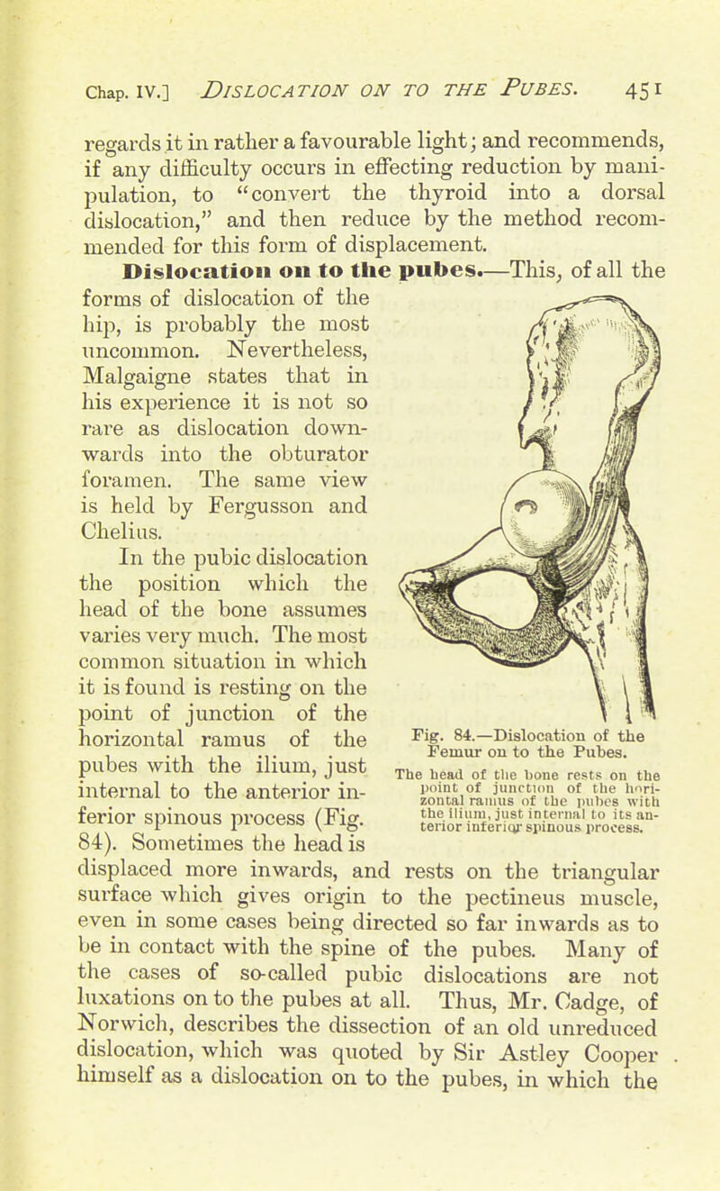 regai'ds .it in rather a favourable light; and recommends, if any difficulty occurs in effecting reduction by mani- pulation, to convert the thyroid into a dorsal dislocation, and then reduce by the method recom- mended for this form of displacement. Dislocation on to the pubes.—This, of all the forms of dislocation of the hip, is probably the most uncommon. Nevertheless, Malgaigne states that in his experience it is not so rai-e as dislocation down- wards into the obturator foramen. The same view is held by Fergusson and Chelius. In the pubic dislocation the position which the head of the bone assumes varies very much. The most common situation in which it is found is resting on the point of junction of the horizontal ramus of the pubes with the ilium, just ^he head of the bone rests on the internal to the anterior in- z^r^i^rinjur^'^'The^'puts '7ti; ferior spinous process (Fig. t^^^iriifeii^'ijino'us^^roieL! 84). Sometimes the head is displaced more inwards, and rests on the triangular surface which gives origin to the pectineus muscle, even in some cases being directed so far inwards as to be in contact with the spine of the pubes. Many of the cases of so-called pubic dislocations are not luxations on to the pubes at all. Thus, Mr. Cadge, of Norwich, describes the dissection of an old unreduced dislocation, which was quoted by Sir Astley Cooper himself as a dislocation on to the pubes, in which the Fig. 84.—Dislocation of the Femur on to the Pubes.