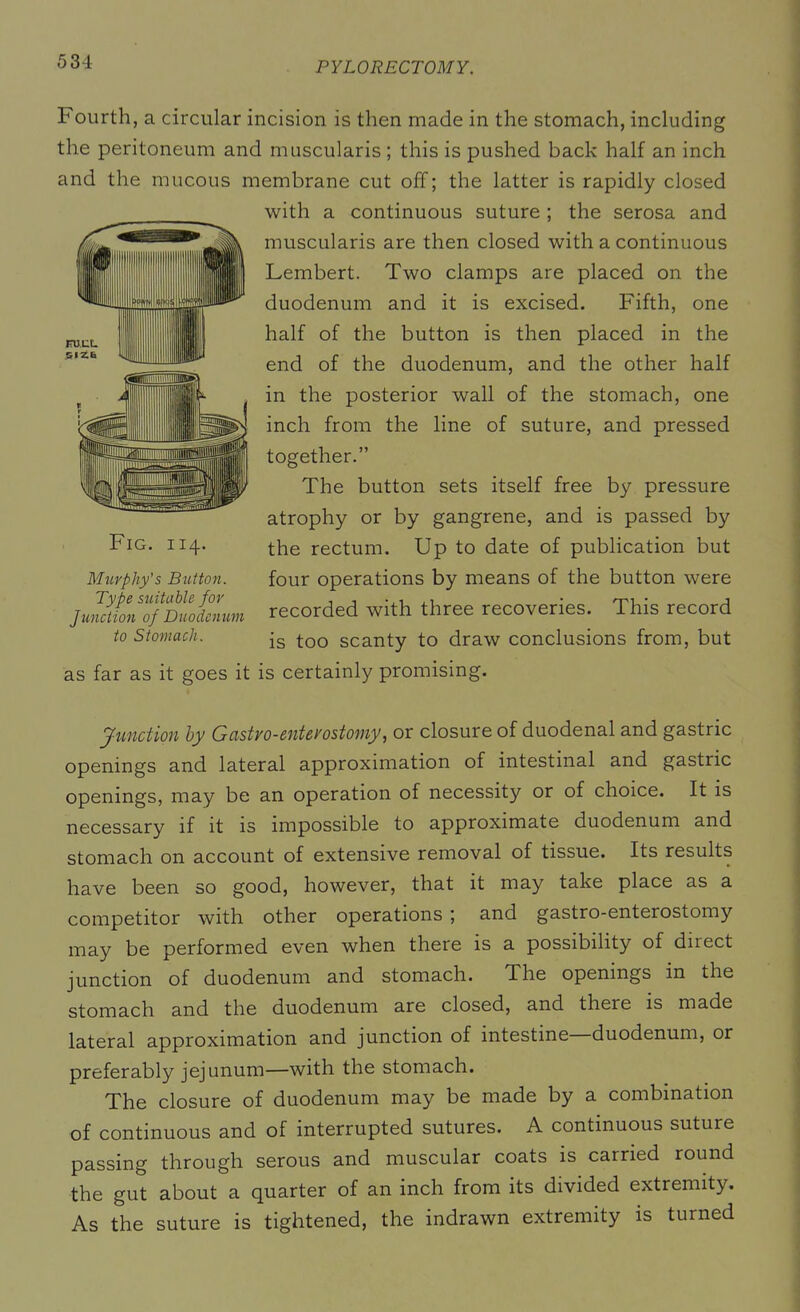 Fourth, a circular incision is then made in the stomach, including the peritoneum and muscularis ; this is pushed back half an inch and the mucous membrane cut off; the latter is rapidly closed with a continuous suture ; the serosa and muscularis are then closed with a continuous Lembert. Two clamps are placed on the duodenum and it is excised. Fifth, one half of the button is then placed in the end of the duodenum, and the other half in the posterior wall of the stomach, one inch from the line of suture, and pressed together.” The button sets itself free by pressure atrophy or by gangrene, and is passed by the rectum. Up to date of publication but four operations by means of the button were recorded with three recoveries. This record is too scanty to draw conclusions from, but as far as it goes it is certainly promising. Junction by Gcistro-enteyostoniy, or closure of duodenal and gastric openings and lateral approximation of intestinal and gastric openings, may be an operation of necessity or of choice. It is necessary if it is impossible to approximate duodenum and stomach on account of extensive removal of tissue. Its results have been so good, however, that it may take place as a competitor with other operations ; and gastro-enterostomy may be performed even when there is a possibility of direct junction of duodenum and stomach. The openings in the stomach and the duodenum are closed, and there is made lateral approximation and junction of intestine duodenum, or preferably jejunum—with the stomach. The closure of duodenum may be made by a combination of continuous and of interrupted sutures. A continuous suture passing through serous and muscular coats is carried round the gut about a quarter of an inch from its divided extremity. As the suture is tightened, the indrawn extremity is turned Fig. 114. Murphy's Button. Type suitable for Junction of Duodenum to Stomach.