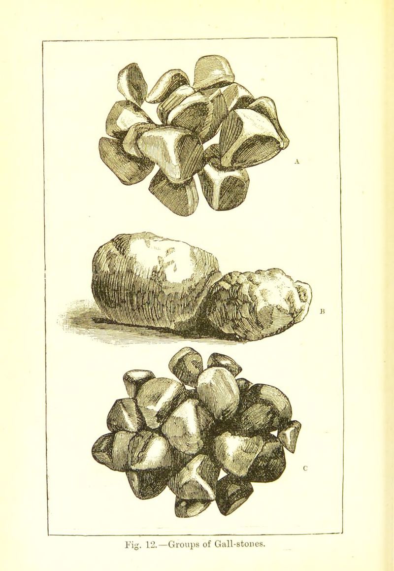 Fig. 12.—Gro^ips of Gnll-stoiies.