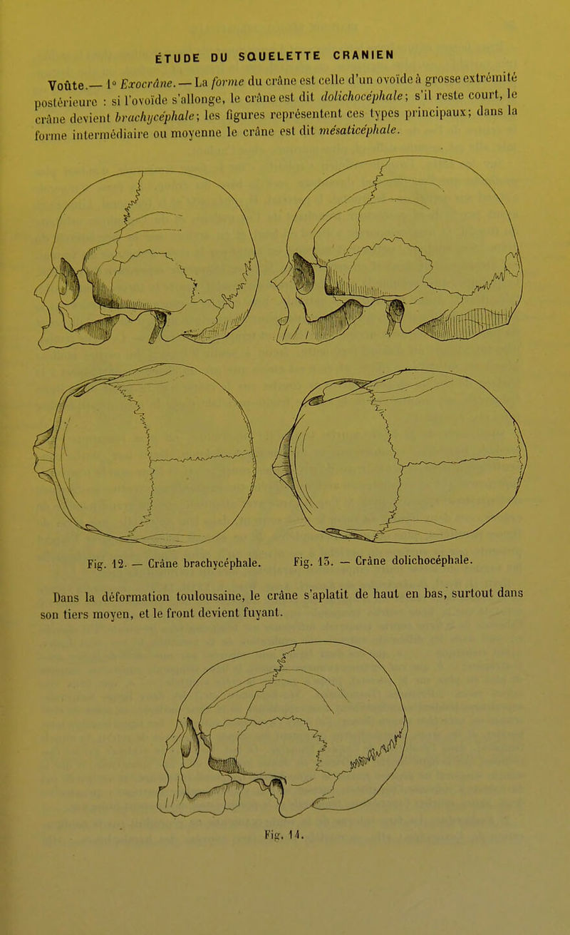 ÉTUDE DU SQUELETTE CRANIEN Voûte.— 1 Exocrâne. — La forme du crâne est celle d'un ovoïde à grosse extrémité postérieure : si lovoïde s'allonge, le crâne est dit dolichocéphale; s'il reste court, le crâne devient brachycéphale; les figures représentent ces types principaux; dans la forme intermédiaire ou moyenne le crâne est dit mésatice'phale. Fig. 12. — Crâne brachycéphale. Fig. 13. — Crâne dolichocéphale. Dans la déformation toulousaine, le crâne s'aplatit de haut en bas, surtout dans son tiers moyen, et le front devient fuyant. Fig. 14.