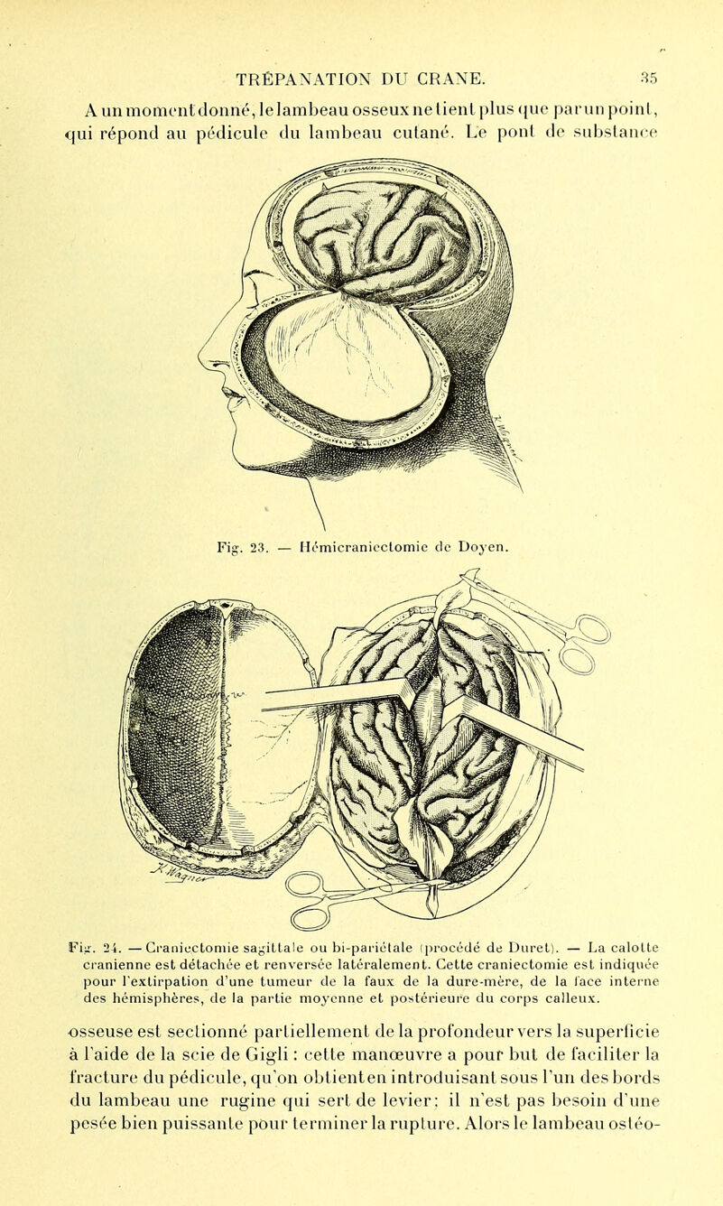 A un moment donné, le lambeau osseux ne lient plus (jue parun point, qui répond au pédicule du lambeau cutané. Le ponl de .-substance Fig. 23. — Hémicranieclomie de Doyen. Fi.u. 24. —Granicctoniie sapdltale ou bi-pariélale (procédé de Diiret). — La caloUe crânienne est détachée et renversée latéralement. Cette craniectomie est indiquée pour l'extirpation d'une tumeur de la faux de la dure-mère, de la lace interne des hémisphères, de la partie moyenne et postérieure du corps calleux. osseuse est sectionné partiellement de la profondeur vers la superficie à Taide de la scie de Gigli : cette manœuvre a pour but de faciliter la fracture du pédicule, qu'on obtienten introduisant sous l'un des bords du lambeau une rugine qui sert de levier: il n'est pas besoin d'une pesée bien puissante pour terminer la rupture. Alors le lambeau ostéo-