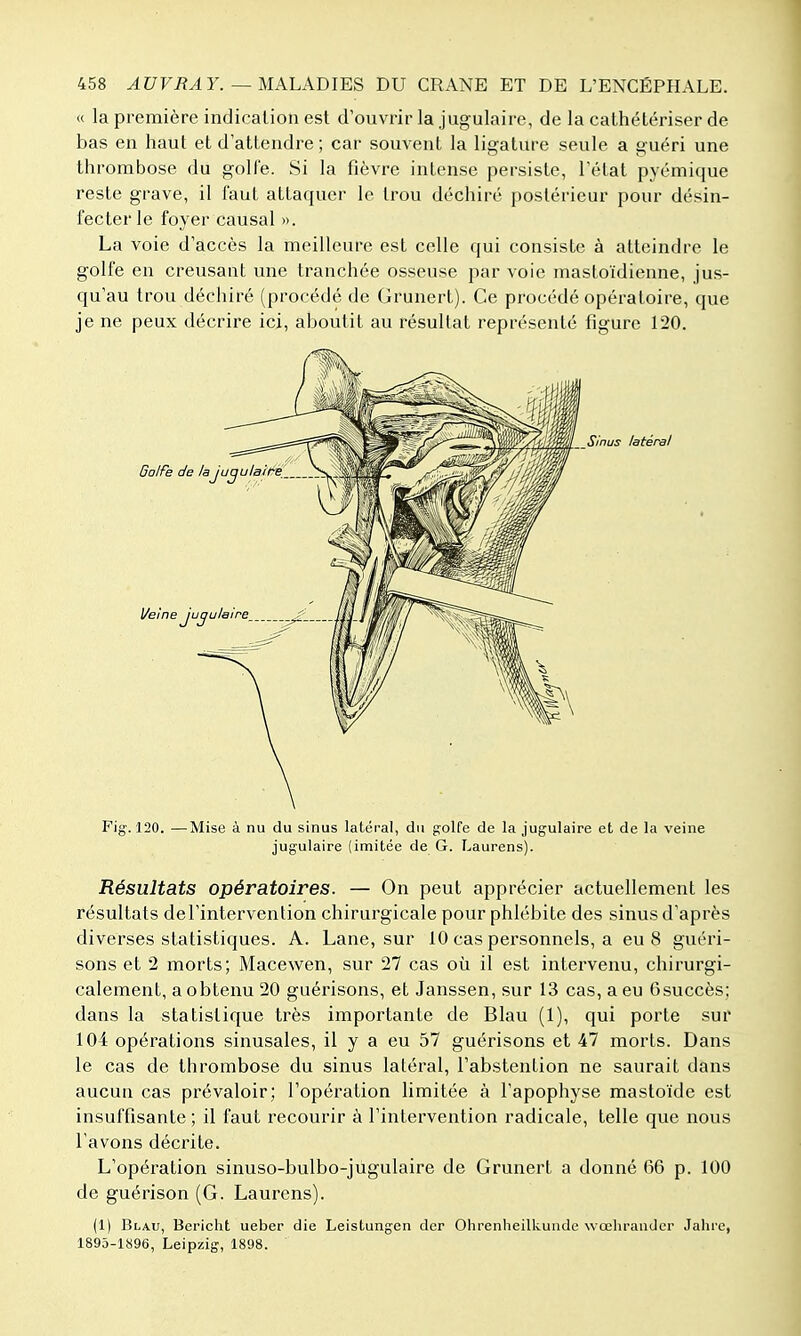 « la première indication est d'ouvrir la jugulaire, de la cathétériser de bas en haut et d'attendre; car souvent la ligature seule a guéri une thrombose du golfe. Si la fièvre intense persiste, l'état pyémique reste grave, il faut attaquer le trou déchiré postérieur pour désin- fecter le foyer causal ». La voie d'accès la meilleure est celle qui consiste à atteindre le golfe en creusant une tranchée osseuse par voie mastoïdienne, jus- qu'au trou déchiré (procédé de Grunert). Ce procédé opératoire, que je ne peux décrire ici, aboutit au résultat représenté figure 120. Fig. 120. —Mise à nu du sinus latéral, du golfe de la jugulaire et de la veine jugulaire (imitée de G. Laurens). Résultats opératoires. — On peut apprécier actuellement les résultats del'intervention chirurgicale pour phlébite des sinus d'après diverses statistiques. A. Lane, sur 10 cas personnels, a eu 8 guéri- sons et 2 morts; Macewen, sur 27 cas où il est intervenu, chirurgi- calement, a obtenu 20 guérisons, et Janssen, sur 13 cas, a eu Gsuccès; dans la statistique très importante de Blau (1), qui porte sur 104 opérations sinusales, il y a eu 57 guérisons et 47 morts. Dans le cas de thrombose du sinus latéral, l'abstention ne saurait dans aucun cas prévaloir; l'opération limitée à l'apophyse mastoïde est insuffisante; il faut recourir à l'intervention radicale, telle que nous l'avons décrite. L'opération sinuso-bulbo-jugulaire de Grunert a donné 66 p. 100 de guérison (G. Laurens). (1) Blau, Bericht ueber die Leistungen dcr Ohrenheilkundc wœhrauder Jahrc, 1895-1896, Leipzig, 1898.