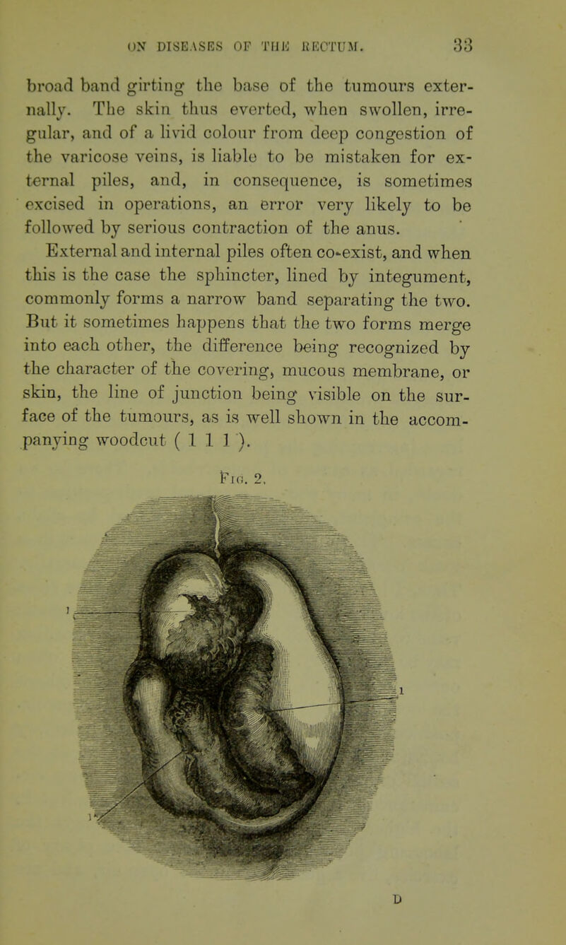 broad band girting the base of the tumours exter- nally. The skin thus everted, when swollen, irre- gular, and of a livid colour from deep congestion of the varicose veins, is liable to be mistaken for ex- ternal piles, and, in consequence, is sometimes excised in operations, an error very likely to be followed by serious contraction of the anus. External and internal piles often co-exist, and when this is the case the sphincter, lined by integument, commonly forms a narrow band separating the two. But it sometimes happens that the two forms merge into each other, the difference being recognized by the character of the covering, mucous membrane, or skin, the line of junction being visible on the sur- face of the tumours, as is well shown in the accom- panying woodcut (1 1 1 ). ^ic. 2.