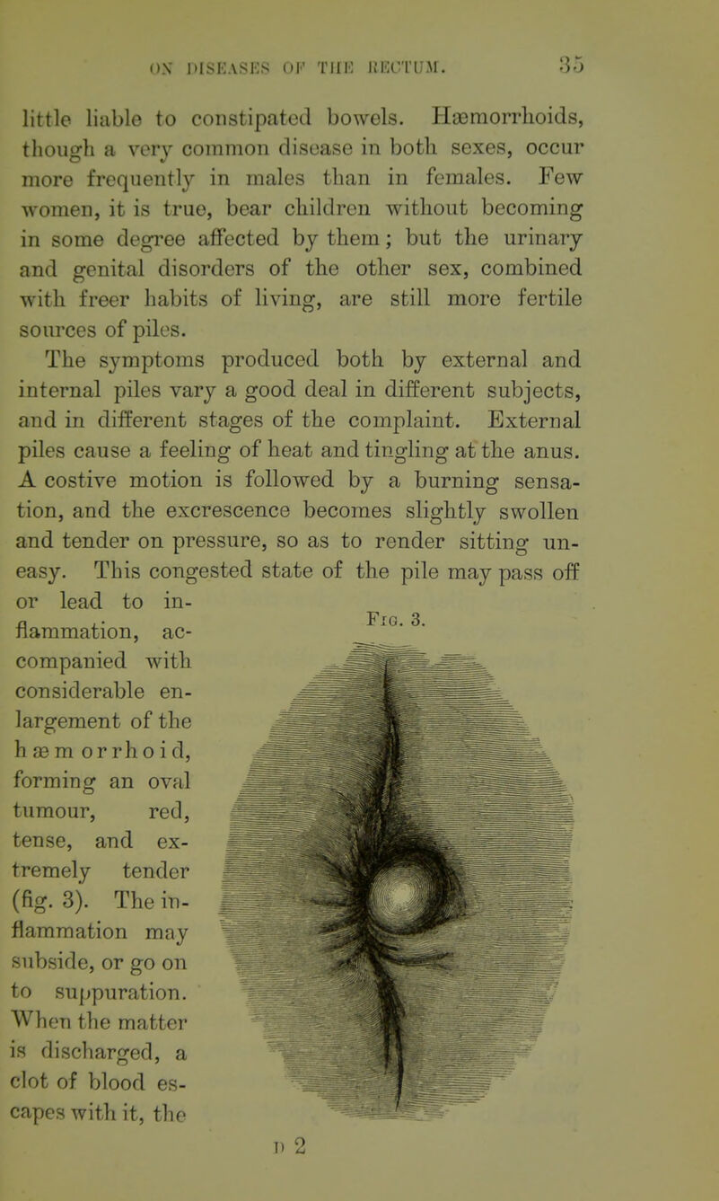little liable to constipated bowels. Hsemorrlioids, though a very common disease in both sexes, occur more frequently in males than in females. Few women, it is true, bear children without becoming in some degree affected by them; but the urinary and genital disorders of the other sex, combined with freer habits of living, are still more fertile sources of piles. The symptoms produced both by external and internal piles vary a good deal in different subjects, and in different stages of the complaint. External piles cause a feeling of heat and tingling at the anus. A costive motion is followed by a burning sensa- tion, and the excrescence becomes slightly swollen and tender on pressure, so as to render sitting un- easy. This congested state of the pile may pass off or lead to in- flammation, ac- companied with considerable en- largement of the h a6m orrhoid, forming an oval tumour, red, tense, and ex- tremely tender (fig. 3). The in- flammation may \. ^ - subside, or go on to suppuration. When the matter is discharged, a clot of blood es- capes with it, the 1) 2 Fig. 3.