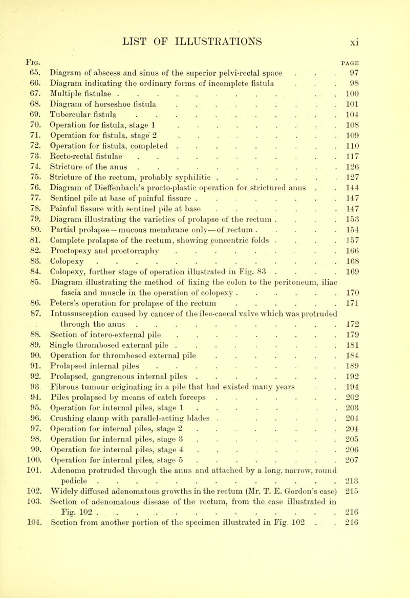 Fig. page 65. Diagram of abscess and sinus of the superior pelvi-rectal space , ; . . 97 66. Diagram indicating the ordinary forms of incomplete fistula . . . . . 98 67. Multiple fistulae 100 68. Diagram of horseshoe fistula ......... 101 69. Tubercular fistula . . . . . . . ...... 104 70. Operation for fistula, stage 1 . . . . . . . ' . 108 71. Operation for fistula, stage 2 ......... 109 72. Operation for fistula, completed . . . . . . . . .110 73. Eecto-rectal tistulae . . . . . . . . . .117 74. Stricture of the anus . . . . . . . . . . .126 75. Stricture of the rectum, probably syphilitic ....... 127 76. Diagram of Dieffenbach's procto-plastic operation for strictured anus . . 144 77. Sentinel pile at base of painful fissure . . . . . . . .147 78. Painful fissure with .sentinel pile at base ....... 147 79. Diagram illustrating the varieties of prolapse of the rectum .... 153 80. Partial prolapse—mucous membrane onlj'—of rectum . .... 154 81. Complete prolapse of the rectum, showing concentric folds . . . .157 82. Proctopexy and proctorraphy ......... 166 83. Colopexy 168 84. Colopexy, further stage of operation illustrated in Fig. 83 . . . . 169 85. Diagram illustrating the method of fi.xing the colon to the peritoneum, iliac fascia and muscle in the operation of colopexy . . . . . .170 86. Peters's operation for prolapse of the rectum . . . . . .171 87. Intussusception caused by cancer of the ileo-caecal valve which was protruded through the anus . . . . . . . . . . .172 88. Section of intero-external pile . . . . . . . . .179 89. Single thrombosed external pile ......... 181 90. Operation for thrombosed external pile ....... 184 91. Prolapsed internal piles .......... 189 92. Prolapsed, gangrenous internal piles ........ 192 93. Fibrous tumour originating in a pile that had existed many years . . 194 94. Piles prolapsed by means of catch forcejjs ....... 202 95. Operation for internal piles, stage 1 .... . . . 203 96. Crushing clamp with parallel-acting blades ...... 204 97. Operation for internal piles, stage 2 ....... . 204 98. Operation for internal piles, stage 3 ....... . 205 99. Operation for internal piles, stage 4 ....... . 206 100. Operation for internal piles, stage 5 ....... . 207 101. Adenoma protruded through the anus and attached by a long, narrow, round pedicle ............. 213 102. Widely diffused adenomatous growths in the rectum (Mr. T. E. Gordon's case) 215 103. Section of adenomatous disease of the rectum, from the case illustrated in Fig. 102 216 1.04. Section from another portion of the specimen illustrated in Fig. 102 . .216