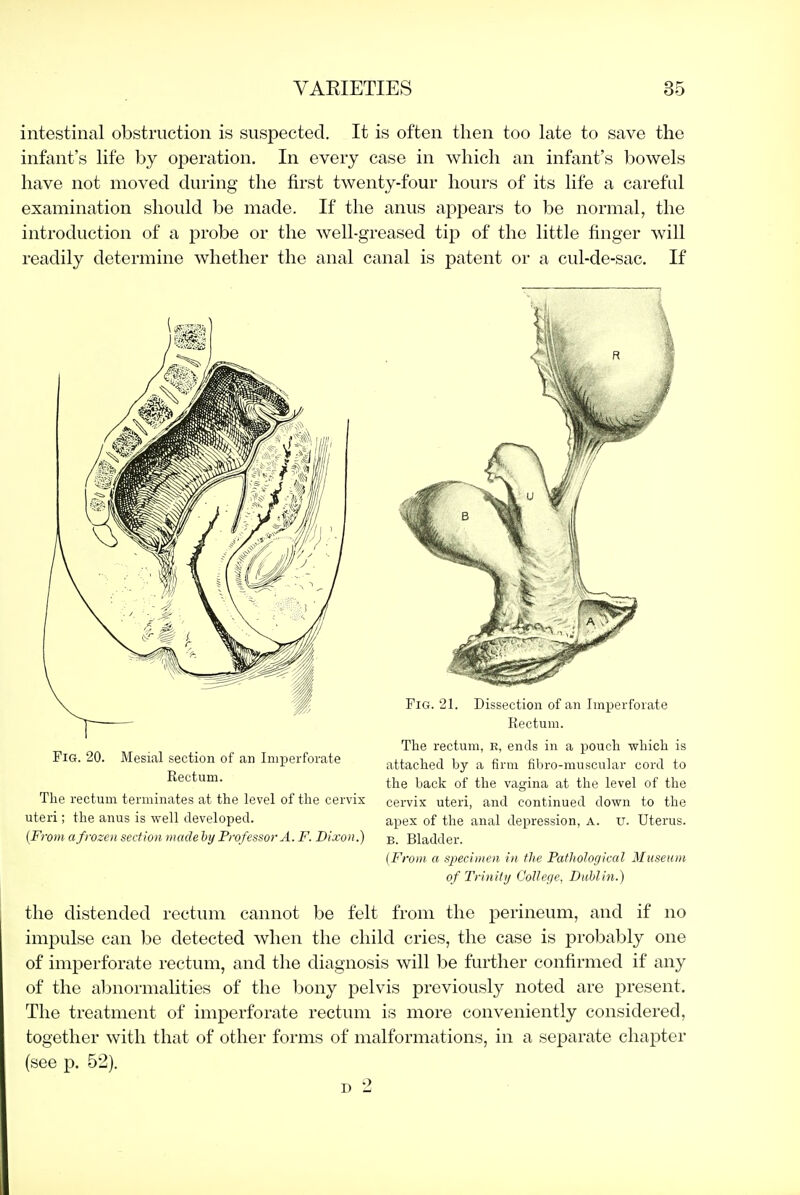 intestinal obstruction is suspected. It is often then too late to save the infant's life by operation. In every case in which an infant's bowels have not moved during the first twenty-four hours of its life a careful examination should be made. If the anus appears to be normal, the introduction of a probe or the well-greased tip of the little finger will readily determine whether the anal canal is patent or a cul-de-sac. If Fig. 20. Mesial section of an Imperforate Rectum. The rectum terminates at the level of the cervix uteri; the anus is well developed. {From a frozen section made hy Professor A. F. Dixon.) Fig. 21. Dissection of an Imperforate Rectum. The rectum, E, ends in a pouch which is attached by a firm fibro-muscular cord to the back of the vagina at the level of the cervix uteri, and continued down to the apex of the anal depression, a. u. Uterus. B. Bladder. {From a specimen in the Pathological Museum of Trinity College, Dublin.) the distended rectum cannot be felt from the perineum, and if no impulse can be detected when the child cries, the case is probably one of imperforate rectum, and the diagnosis will be further confirmed if any of the abnormalities of the bony pelvis previously noted are present. The treatment of imperforate rectum is more conveniently considered, together with that of other forms of malformations, in a separate chapter (see p. 52). D 2