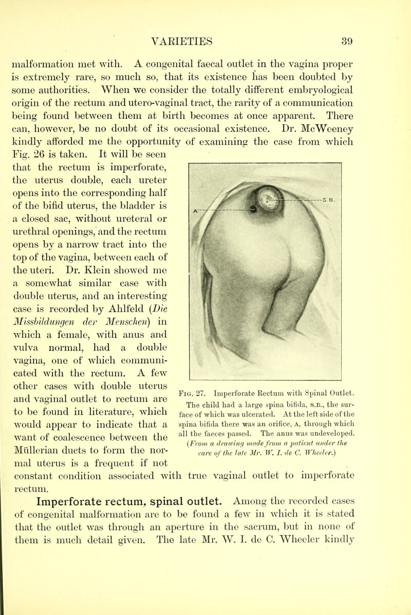 malformation met with. A congenital faecal outlet in the vagina proper is extremely rare, so much so, that its existence has been doubted by some authorities. When we consider the totally different embryological origin of the rectum and utero-vaginal tract, the rarity of a communication being found between them at birth becomes at once apparent. There can, however, be no doubt of its occasional existence. Dr. McWeeney kindly afforded me the opportunity of examining the case from which Fig. 26 is taken. It will be seen that the rectum is imperforate, the uterus double, each ureter opens into the corresponding half of the bifid uterus, the bladder is a closed sac, without ureteral or urethral openings, and the rectum opens by a narrow ti-act into the top of the vagina, between each of the uteri. Dr. Klein showed me a somewhat similar case with double uterus, and an interesting case is recorded by Ahlfeld {Die Misshildungen der Menschen) in which a female, with anus and vulva normal, had a double vagina, one of which communi- cated with the rectum, A few other cases with double uterus and vaginal outlet to rectum are to be found in literature, which would appear to indicate that a want of coalescence between the Mlillerian ducts to form the nor- mal uterus is a frequent if not constant condition associated with true vaginal outlet to imperforate rectum. Imperforate rectum, spinal outlet. Among the recorded cases of congenital malformation are to be found a few in which it is stated that the outlet was through an aperture in the sacrum, but in none of them is much detail given. The late Mr. W. I. de C. Wheeler kindly Fig. 27. Imperforate Rectum with Spinal Outlet. The child had a large spina bifida, s.b., the sur- face of which was ulcerated. At the left side of the spina bifida there was an orifice, A, through which all the faeces passed. The anus was undeveloped. (From a drawing made from a patient under the care of the late Mr. W. I. de C. Wieeler.)