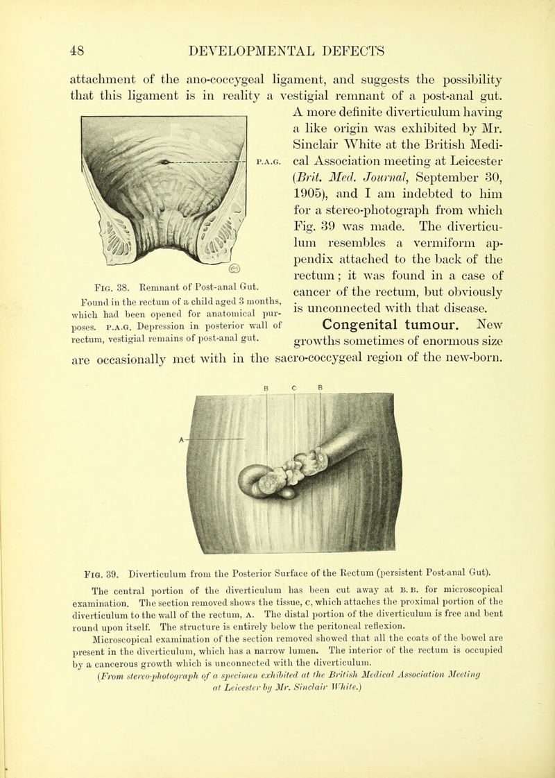 P.A.G. attachment of the ano-coccygeal hgament, and suggests the possibility that this hgament is in reahty a vestigial remnant of a post-anal gut. A more definite diverticulum having a like origin was exhibited by Mr. Sinclair White at the British Medi- cal Association meeting at Leicester {Brit. Med. Journal, September 30, 1905), and I am indebted to him for a stereo-photograph from which Fig. 39 was made. The diverticu- lum resembles a vermiform ap- pendix attached to the back of the rectum; it was found in a case of cancer of the rectum, but obviously is unconnected with that disease. Congenital tumour. New growths sometimes of enormous size are occasionally met with in the sacro-coccygeal region of the new-born. Fig. 38. Remnant of Post-anal Gut. Found in the rectum of a child aged 3 months, which had been opened for anatomical jDur- poses. P.A.G. Depression in posterior wall of rectum, vestigial remains of post-anal gut. Fig. 39. Diverticulum from the Posterior Surface of the Rectum (persistent Post-anal Gut). The central portion of the diverticulum has been cut away at b. b. for microscopical examination. The section removed shows the tissue, c, which attaches the proximal portion of the diverticulum to the wall of the rectum, A. The distal portion of the diverticulum is free and bent round upon itself The structure is entirely below the peritoneal reflexion. Microscopical examination of the section removed showed that all the coats of the bowel are present in the diverticulum, which has a narrow lumen. The interior of the rectum is occupied by a cancerous growth which is unconnected with the diverticulum. {From stereo-jjhotorjrcrph of a specimen, exhihited at /he British Medical Association Meeting at Leicester hy Mr. Sinclair White.)