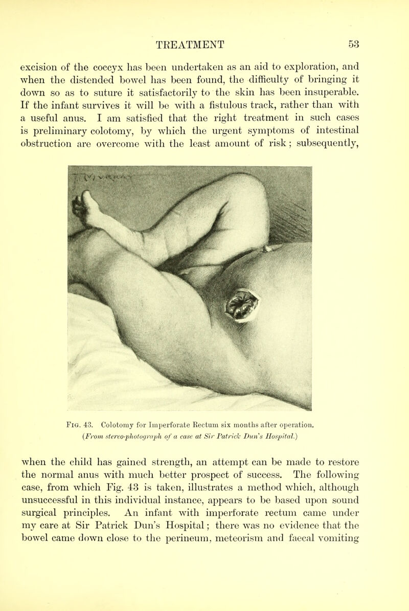 excision of the coccyx has been undertaken as an aid to exploration, and when the distended bowel has been found, the difficulty of bringing it down so as to suture it satisfactorily to the skin has been insuperable. If the infant survives it will be with a fistulous track, rather than with a useful anus. I am satisfied that the right treatment in such cases is preliminary colotomy, b}^ which the urgent symptoms of intestinal obstruction are overcome with the least amount of risk; subsequently, Fig. 43. Colotomy for Imperforate Rectum sis months after operation. {Fivm stereo-photograph of a case at Sir Patrick Duns Hospital.) when the child has gained strength, an attempt can be made to restore the normal anus with much better prospect of success. The following case, from which Fig. 43 is taken, illustrates a method which, although unsuccessful in this individual instance, appears to be based upon sound surgical principles. An infant with imperforate rectum came under my care at Sir Patrick Dun's Hospital; there was no evidence that the bowel came down close to the perineum, meteorism and faecal vomiting