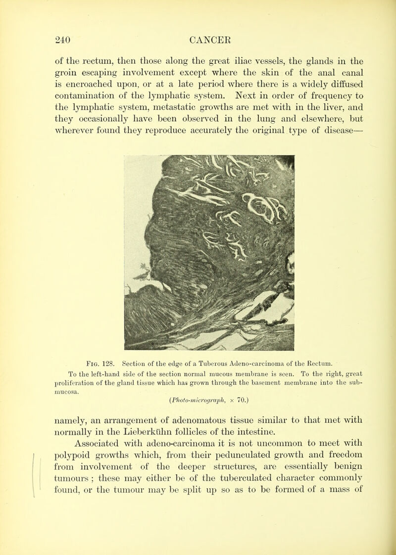 of the rectum, then those along the great ihac vessels, the glands in the groin escaping involvement except where the skin of the anal canal is encroached upon, or at a late period where there is a widely diffused contamination of the lymphatic system. Next in order of frequency to the lymphatic system, metastatic growths are met with in the liver, and they occasionally have been observed in the lung and elsewhere, but wherever found they reproduce accurately the original type of disease— Fig. 128. Section of the edge of a Tuberous Adeno-carcinoma of the Rectum. To the left-hand side of the section normal mucous membrane is seen. To the right, great proliferation of the gland tissue which has grown through the basement membrane into the sub- mucosa. {Plioto-microgrwph, x 70.) namely, an arrangement of adenomatous tissue similar to that met with normally in the Lieberkiihn follicles of the intestine. Associated with adeno-carcinoma it is not uncommon to meet with polypoid growths which, from their pedunculated growth and freedom from involvement of the deeper structures, are essentially benign tumours ; these may either be of the tuberculated character commonly found, or the tumour may be split up so as to be formed of a mass of