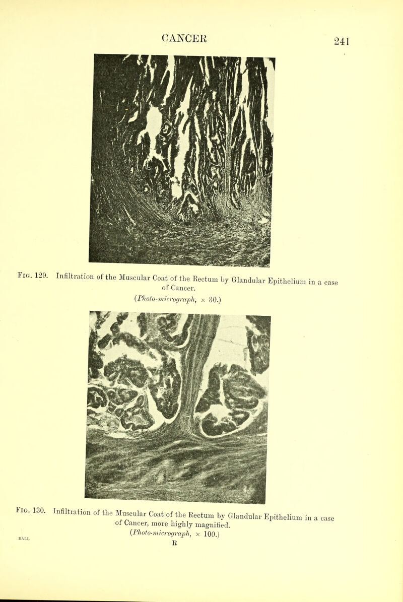 Fig. 129. Infiltration of the Muscular Coat of the Rectum by Glandular Epithelium in a case of Cancer. {Photo-micrograph, x 30.) FIG. 130. Infiltration of the Muscular Coat of the Kectum by Glandular Epithelium in a case ot Lancer, more highly magnified. {Photo-micrograph, x 100 ) BALL . J. I / E