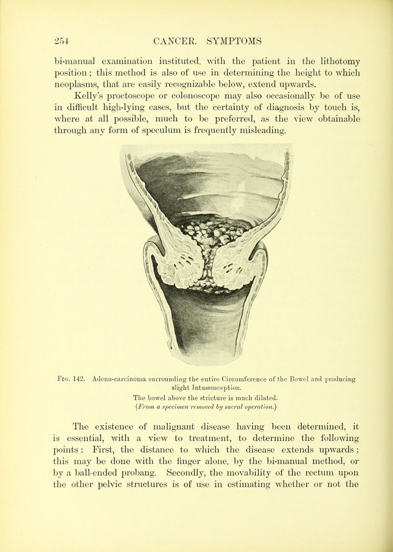 bi-manual examination instituted, with the patient in the hthotomy position; this method is also of use in determining the height to which neoplasms, that are easily recognizable below, extend upwards. Kelly's proctoscope or colonoscope may also occasionally be of use in difficult high-lying cases, but the certainty of diagnosis by touch is, where at all possible, much to be preferred, as the view obtainable through any form of speculum is frequently misleading. Fig. 142. Adeno-carcinoma surrounding the entire Circumference of the Bowel and producing slight Intussusception. The bowel above the stricture is much dilated. {From a specimen removed hy sacral operation.) The existence of malignant disease having been determined, it is essential, with a view to treatment, to determine the following j)oints: First, the distance to which the disease extends upwards; this may be done with the finger alone, by the bi-manual method, or by a ball-ended probang. Secondly, the movability of the rectum upon the other pelvic structures is of use in estimating whether or not the