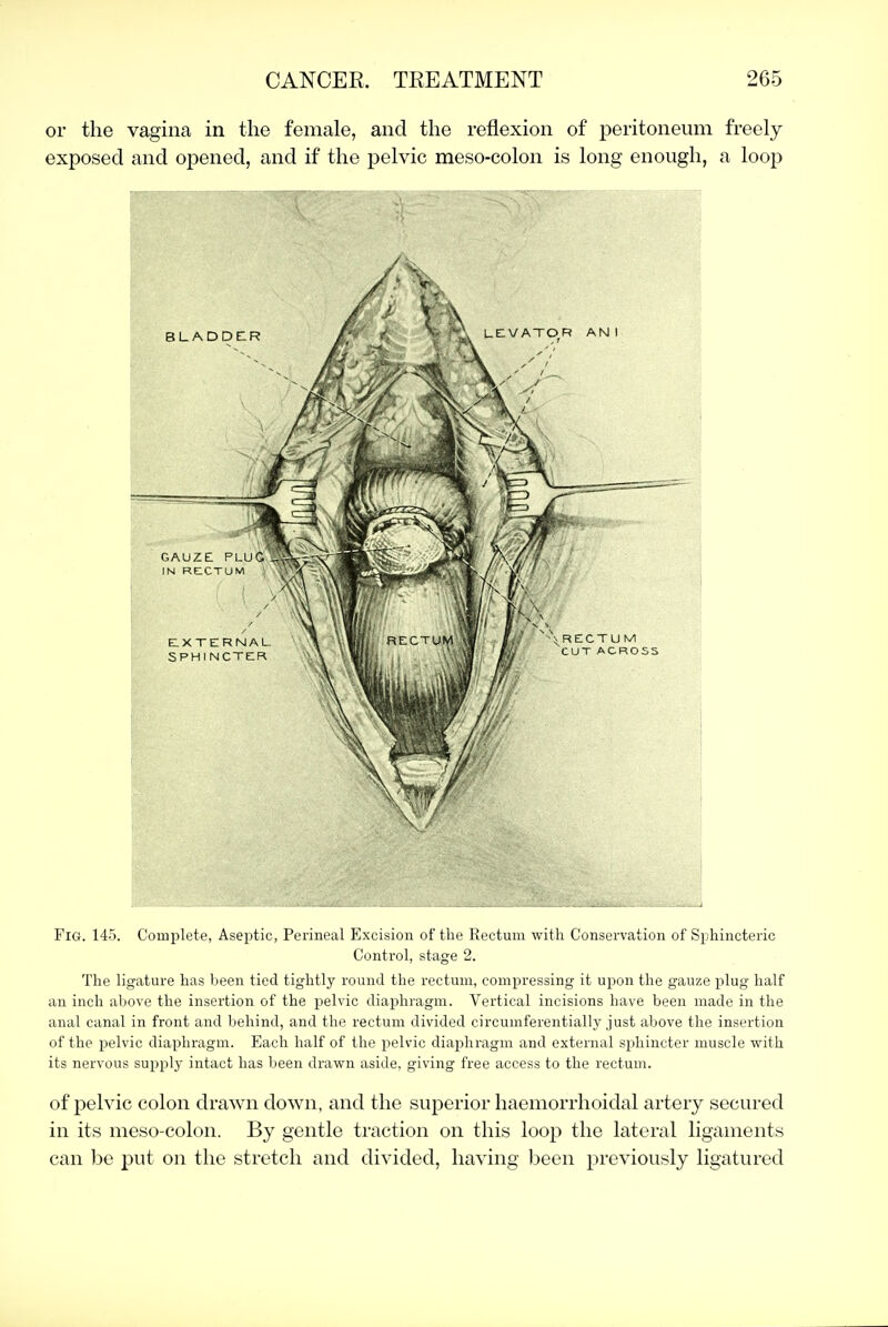 or the vagina in the female, and the reflexion of peritoneum freely exposed and opened, and if the pelvic meso-colon is long enough, a loop Fig. 145. Complete, Aseptic, Perineal Excision of the Rectum with Conservation of Sphincteric Control, stage 2. The ligature has been tied tightly round the rectum, compressing it upon the gauze plug half an inch above the insertion of the pelvic diajjliragm. Vertical incisions have been made in the anal canal in front and behind, and the rectum divided circumferentially just above the insertion of the pelvic diaphragm. Each half of the pelvic diaphragm and external sphincter muscle with its nervous supply intact has been drawn aside, giving free access to the rectum. of pelvic colon drawn down, and the superior haemorrhoidal artery secured in its meso-colon. By gentle traction on this loop the lateral ligaments can be put on the stretch and divided, having been previously ligatured