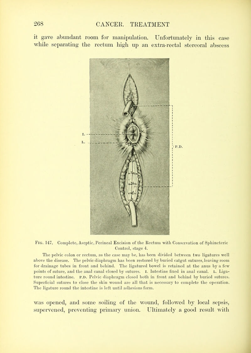 it gave abundant room for manipulation. Unfortunately in this case while separating the rectum high up an extra-rectal stercoral abscess Fig. 147. Complete, Aseptic, Perineal Excision of the Rectum with Conservation of Sphincteric Control, stage 4. The pelvic colon or rectum, as the case may be, has been divided between two ligatures well above the disease. The pelvic diaphragm has been restored by buried catgut sutures, leaving room for drainage tubes in front and behind. The ligatured bowel is retained at the anus by a few points of suture, and the anal canal closed by sutures, i. Intestine fixed in anal canal, l. Liga- ture round intestine. P.d. Pelvic diaphragm closed both in front and behind by buried sutures. Superficial sutures to close the skin wound are all that is necessary to complete the operation. The ligature round the intestine is left until adhesions form. was opened, and some soiling of the wound, followed by local sepsis, supervened, jDreventing primary union. Ultimately a good result with