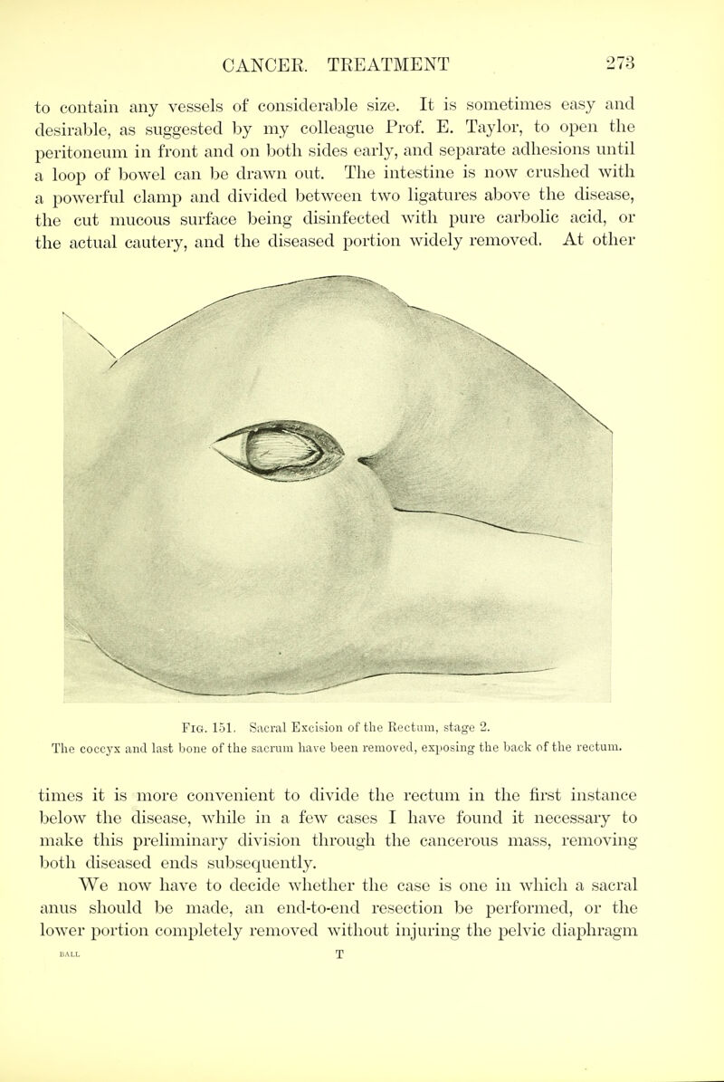 to contain any vessels of considerable size. It is sometimes easy and desirable, as suggested by my colleague Prof. E. Taylor, to open the peritoneum in front and on both sides early, and separate adhesions until a loop of bowel can be drawn out. The intestine is now crushed with a powerful clamp and divided between two ligatures above the disease, the cut mucous surface being disinfected with pure carbolic acid, or the actual cautery, and the diseased portion widely removed. At other Fig. 151, Sacral Excision of the Rectum, stage 2. The coccyx and last bone of the sacrum have been removed, exposing the back of the rectum. times it is more convenient to divide the rectum in the first instance below the disease, while in a fcAV cases I have found it necessary to make this preliminary division through the cancerous mass, removing both diseased ends subsequently. We now have to decide whether the case is one in which a sacral anus should be made, an end-to-end resection be performed, or the lower portion completely removed without injuring the pelvic diaphragm BALL T