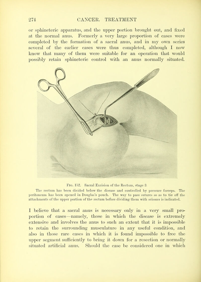 or sphincteric apparatus, and the upper portion brought out, and fixed at the normal anus. Formerly a very large proportion of cases were completed by the formation of a sacral anus, and in my own series several of the earlier cases were thus completed, although I now know that many of them were suitable for an operation that would possibly retain sphincteric control with an anus normally situated. Fig. 152. Sacral Excision of the Rectum, stage 3. The rectum has been divided below the disease and controlled by pressure forceps. The peritoneum has been opened in Douglas's pouch. The way to pass sutures so as to tie off the attachments of the upper portion of the rectum before dividing them with scissors is indicated. I believe that a sacral anus is necessary only in a very small pro- portion of cases—namely, those in which the disease is extremely extensive and involves the anus to such an extent that it is impossible to retain the surrounding musculature in any useful condition, and also in those rare cases in which it is found impossible to free the upper segment sufficiently to bring it down for a resection or normally situated artificial anus. Should the case be considered one in which