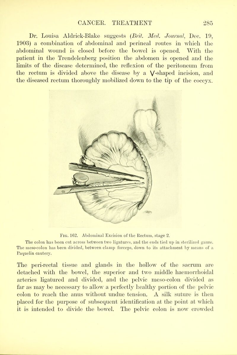 Dr. Louisa Aldrick-Blake suggests (Brif. Med. Journal^ Dec. 19, 1903) a combination of abdominal and perineal routes in which the abdominal wound is closed before the bowel is opened. With the patient in the Trendelenberg position the abdomen is opened and the limits of the disease determined, the reflexion of the peritoneum from the rectum is divided above the disease by a V'Sh^-P^cl incision, and the diseased rectum thoroughly mobilized down to the tip of the coccyx. Fig. 162. Abdominal Excision of the Rectum, stage 2. The colon has been cut across between two ligatures, and the ends tied up in sterilized gauze. The meso-colon has been divided, between clamj) forceps, down to its attachment by means of a Paquelin cautery. The peri-rectal tissue and glands in the hollow of the sacrum are detached with the bowel, the superior and two middle haemorrhoidal arteries ligatured and divided, and the pelvic meso-colon divided as far as may be necessary to allow a perfectly healthy portion of the pelvic colon to reach the anus without undue tension, A silk suture is then placed for the purpose of subsequent identification at the point at which it is intended to divide the bowel. The pelvic colon is now crowded