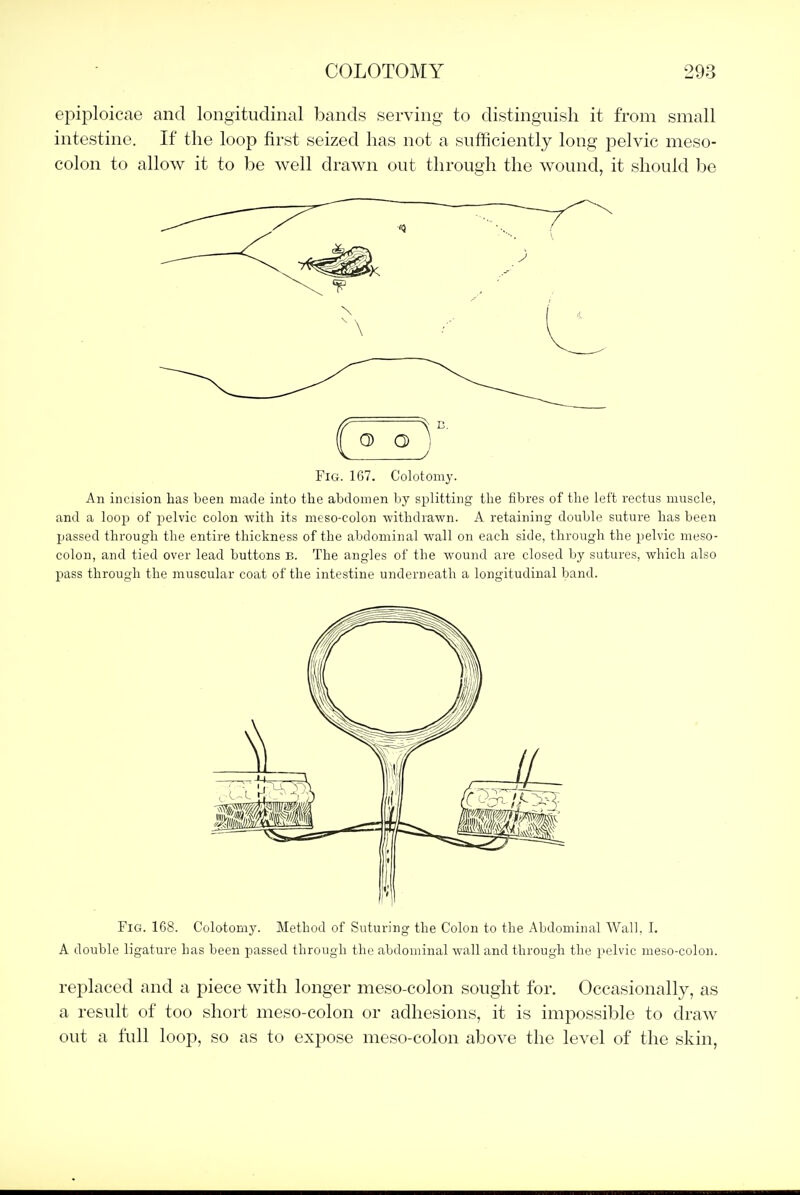 epiploicae and longitudinal bands serving to distinguish it from small intestine. If the loop first seized has not a sufficiently long pelvic meso- colon to allow it to be well drawn out through the wound, it should be Fig. 167. Colotomy. An incision has been made into the abdomen by splitting the iibres of the left rectus muscle, and a loop of pelvic colon with its meso-colon withdrawn. A retaining double suture has been passed through the entire thickness of the abdominal wall on each side, through the pelvic meso- colon, and tied over lead buttons B. The angles of the wound are closed by sutures, which also pass through the muscular coat of the intestine underneath a longitudinal band. Fig. 168. Colotomy. Method of Suturing the Colon to the Abdominal Wall. I. A double ligature has been passed through the abdominal wall and through the pelvic meso-colon. replaced and a piece with longer meso-colon sought for. Occasionally, as a result of too short meso-colon or adhesions, it is impossible to draw out a full loop, so as to expose meso-colon above the level of the skin,