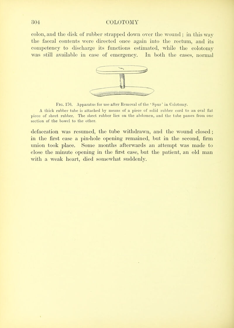 colon, and the disk of rubber strapped down over the wound ; in this way the faecal contents were directed once again into the rectum, and its competency to discharge its functions estimated, while the colotomy was still available in case of emergency. In both the cases, normal Fig. 176. Apparatus for use after Removal of the ' Spur' in Colotomy. A thick rubber tube is attached by means of a piece of solid rubber cord to an oval flat piece of sheet rubber. The sheet rubber lies on the abdomen, and the tube passes from one section of the bowel to the other. defaecation was resumed, the tube withdrawn, and the wound closed; in the first case a pin-hole opening remained, but in the second, firm union took place. Some months afterwards an attempt was made to close the minute opening in the first case, but the patient, an old man with a weak heart, died somewhat suddenly.