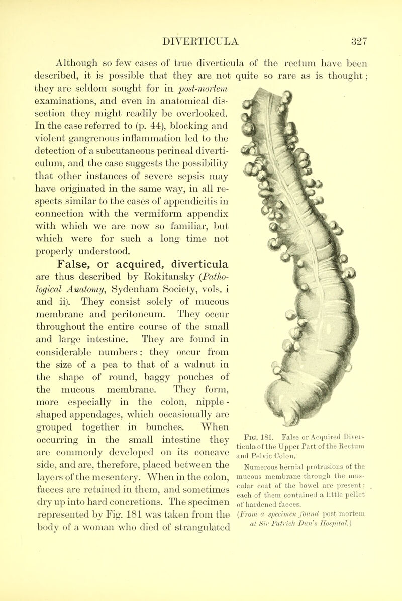 Although so few cases of true diverticula of the rectum have been described, it is possible that they are not quite so rare as is thought; they are seldom sought for in j^ost-mortem examinations, and even in anatomical dis- section they might readily be overlooked. In the case referred to (p. 44), blocking and violent gangrenous inflammation led to the detection of a subcutaneous perineal diverti- culum, and the case suggests the possibility that other instances of severe sepsis may have originated in the same way, in all re- spects similar to the cases of appendicitis in connection with the vermiform appendix with which we are now so familiar, but which were for such a long time not properly understood. False, or acquired, diverticula are thus described by Kokitansky {Fatlio- logical Anatomy, tSydenham Society, vols, i and ii). They consist solely of mucous membrane and peritoneum. They occur throughout the entire course of the small and large intestine. They are found in considerable numbers: they occur from the size of a pea to that of a walnut in the shape of round, baggy pouches of the mucous membrane. They form, more especially in the colon, nipple - shaped appendages, which occasionally are grouped together in bunches. When occurring in the small intestine they are commonly developed on its concave side, and are, therefore, placed between the layers of the mesentery. When in the colon, faeces are retained in them, and sometimes dry up into hard concretions. The specimen represented by Fig. 181 was taken from the body of a woman who died of strangulated Fig. 181. False or Acquired Diver- ticula of the Upper Part of the Fiectum and Pelvic Colon. Numerous hernial protrusions of the mucous membrane through the mus- cular coat of the bowel are present; each of them contained a little pellet of hardened faeces. [From a specimen found post mortem at Sir Patrick Dun's Hospital.)