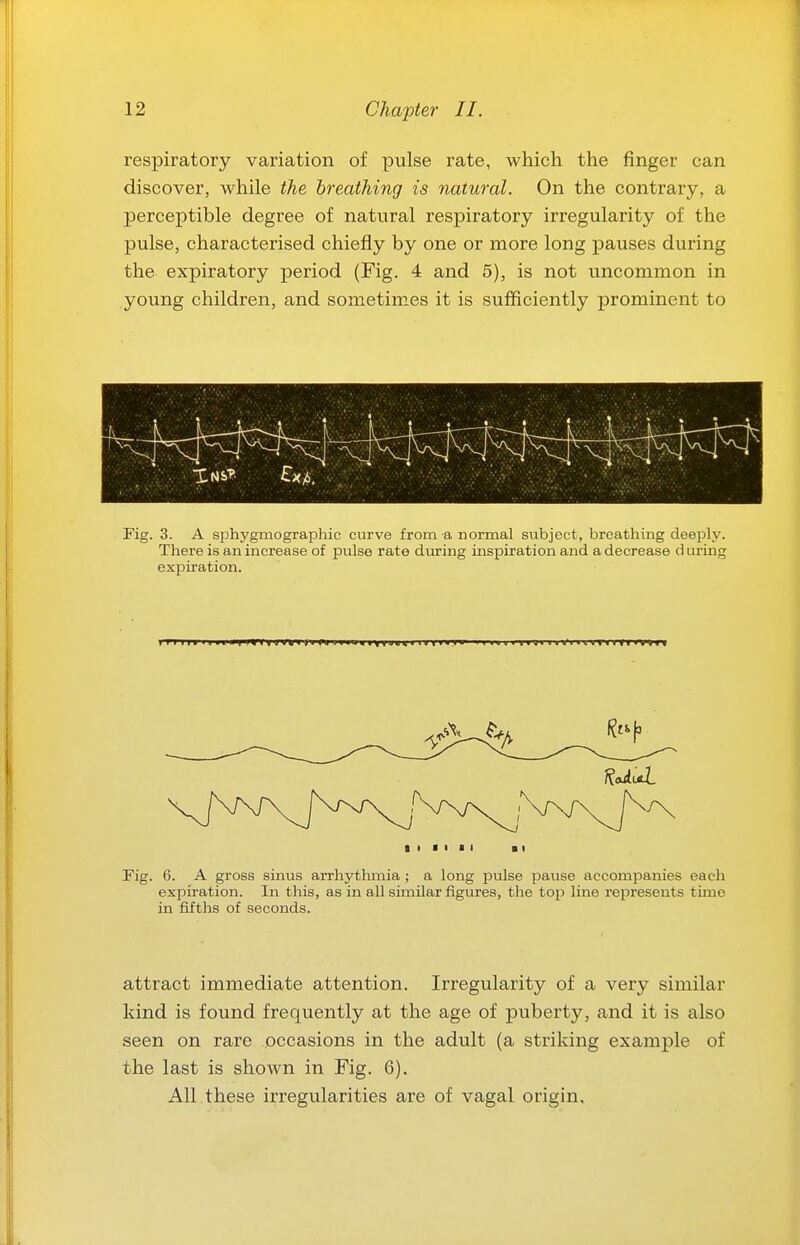 respiratory variation of pulse rate, which the finger can discover, while the breathing is natural. On the contrary, a perceptible degree of natural respiratory irregularity of the pulse, characterised chiefly by one or more long pauses during the expiratory period (Fig. 4 and 5), is not uncommon in young children, and sometimes it is sufficiently prominent to Fig. 3. A sphygmographic curve from a normal subject, breathing deeply. There is an increase of pulse rate during inspiration and a decrease d uring expiration. Fig. 6. A gross sinus arrhythmia; a long pulse pause accompanies each expiration. In this, as in all similar figures, the top line represents time in fifths of seconds. attract immediate attention. Irregularity of a very similar kind is found frequently at the age of puberty, and it is also seen on rare occasions in the adult (a striking example of the last is shown in Fig. 6). All these irregularities are of vagal origin.