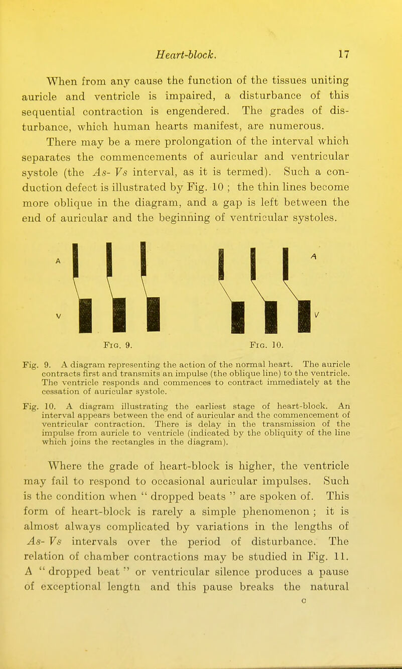 When from any cause the function of the tissues uniting auricle and ventricle is impaired, a disturbance of this sequential contraction is engendered. The grades of dis- turbance, which human hearts manifest, are numerous. There may be a mere prolongation of the interval which separates the commencements of auricular and ventricular systole (the As- Vs interval, as it is termed). Such a con- duction defect is illustrated by Fig. 10 ; the thin lines become more oblique in the diagram, and a gap is left between the end of auricular and the beginning of ventricular systoles. A V Fig. 9. Fig. 10. Fig. 9. A diagram representing the action of the normal heart. The auricle contracts first and transmits an impulse (the oblique line) to the ventricle. The ventricle responds and commences to contract immediately at the cessation of auricular systole. Fig. 10. A diagram illustrating the earliest stage of heart-block. An interval appears between the end of auricular and the commencement of ventricular contraction. There is delay in the transmission of the impulse from auricle to ventricle (indicated by the obliquity of the line which joins the rectangles in the diagram). Where the grade of heart-block is higher, the ventricle may fail to respond to occasional auricular impulses. Such is the condition when  dropped beats  are spoken of. This form of heart-block is rarely a simple phenomenon ; it is almost always complicated by variations in the lengths of As- Vs intervals over the period of disturbance. The relation of chamber contractions may be studied in Fig. 11. A  dropped beat' or ventricular silence produces a pause of exceptional lengtn and this pause breaks the natural