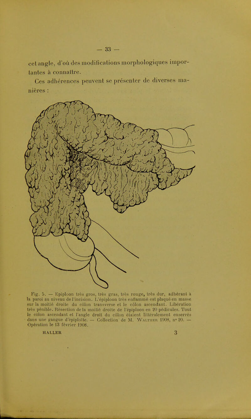 — 33 — cet angle, d'où des modifications morphologiques impor- tantes à connaître. Ces adhérences peuvent se présenter de diverses ma- nières : Fig. 5. — Epiploon très gros, très gras, très rouge, Irès dur, adhérant à la paroi au niveau de l'incision. I^'épiploon Irès enllainmé est plaqué en niasse sur la moitié droite du côlon transverse et le côlon ascendant. Libération très pénible. Résection delà moitié droite de l'épiploon en 20 pédicules. Tout le côlon ascendant et l'angle droit du côlon étaient lilléralcmenl enserrés dans une gangue d'épiploïte. — Collection de M. Waltueu 1008, n° 20. — Opération le 13 février l'J08.