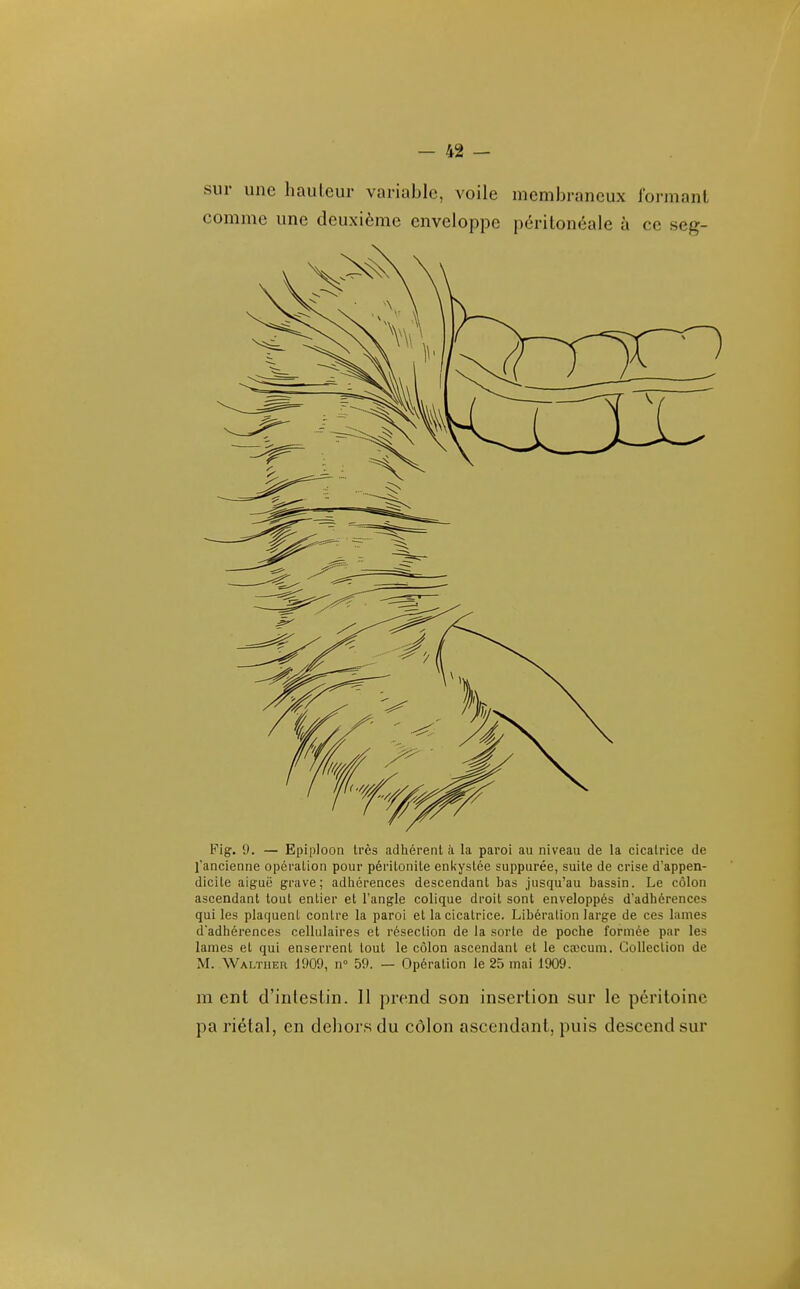 sur une hauteur variable, voile membraneux foi-manl comme une deuxième enveloppe péritonéale à ce seg- Fig. 9. — Epiploon très adhérent à la paroi au niveau de la cicatrice de l'ancienne opération pour péritonite enkystée suppurée, suite de crise d'appen- dicite aiguë grave; adtiérences descendant bas jusqu'au bassin. Le côlon ascendant tout entier et l'angle colique droit sont enveloppés d'adhérences qui les plaquent contre la paroi et la cicatrice. Libération large de ces lames d'adhérences cellulaires et résection de la sorte de poche formée par les lames et qui enserrent tout le côlon ascendant et le cœcum. Collection de M. Walther 1909, n 59. — Opération le 25 mai 1909. m ent d'intestin. 11 prend son insertion sur le péritoine pa riétal, en dehors du côlon ascendant, puis descend sur