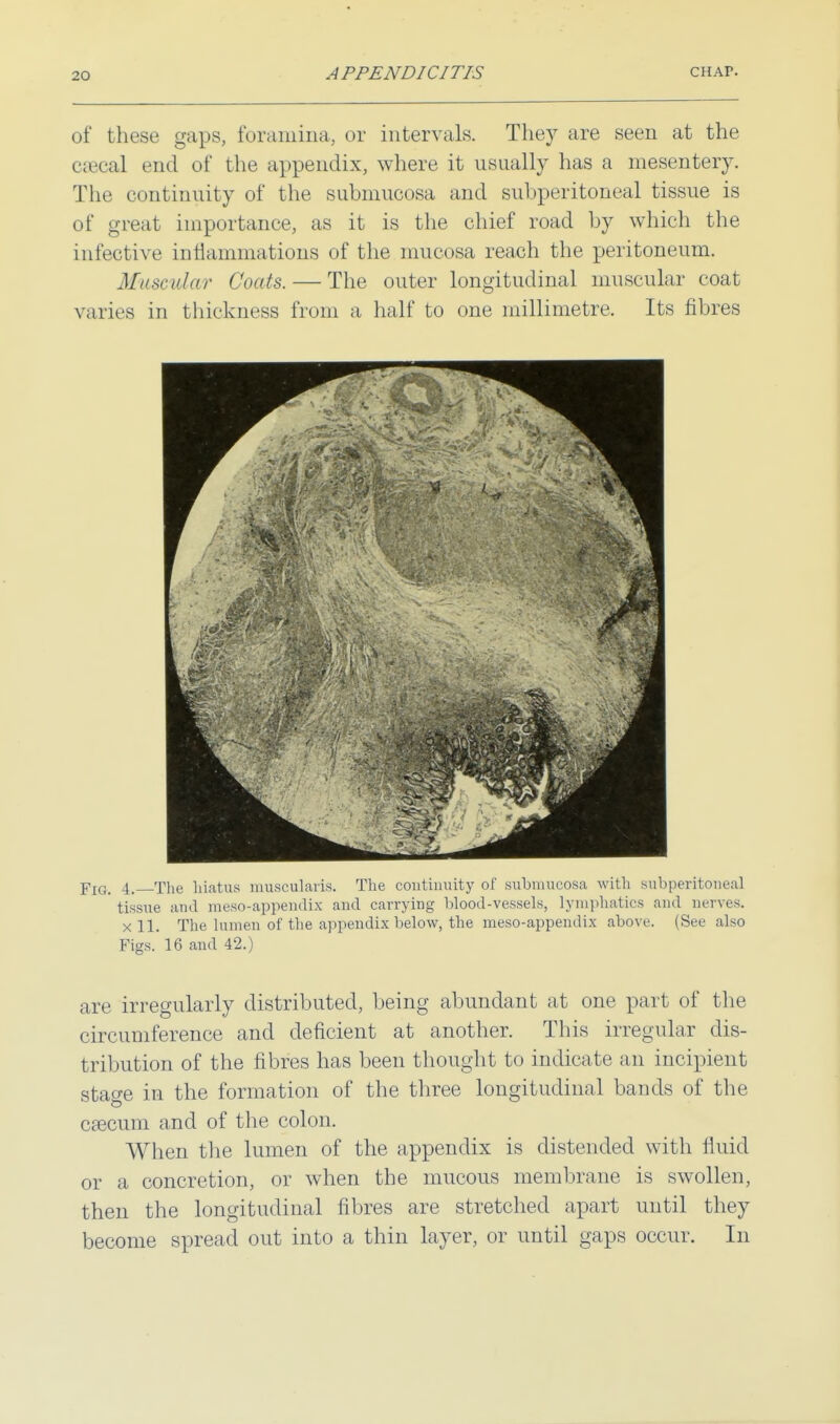 of these gaps, foramina, or intervals. They are seen at the caecal end of the appendix, where it usually has a mesentery. The continuity of the submucosa and subperitoneal tissue is of great importance, as it is the chief road by which the infective inflammations of the mucosa reach the peritoneum. Muscular Cuffs. — The outer longitudinal muscular coat varies in thickness from a half to one millimetre. Its fibres Yiq. 4. The hiatus muscularis. The continuity of submucosa with subperitoneal tissue and meso-appendix and carrying blood-vessels, lymphatics and nerves, x 11. The lumen of the appendix below, the meso-appendix above. (See also Figs. 16 and 42.) are irregularly distributed, being abundant at one part of the circumference and deficient at another. This irregular dis- tribution of the fibres has been thought to indicate an incipient stage in the formation of the three longitudinal bands of the csecum and of the colon. When the lumen of the appendix is distended with fluid or a concretion, or when the mucous membrane is swollen, then the longitudinal fibres are stretched apart until they become spread out into a thin layer, or until gaps occur. In