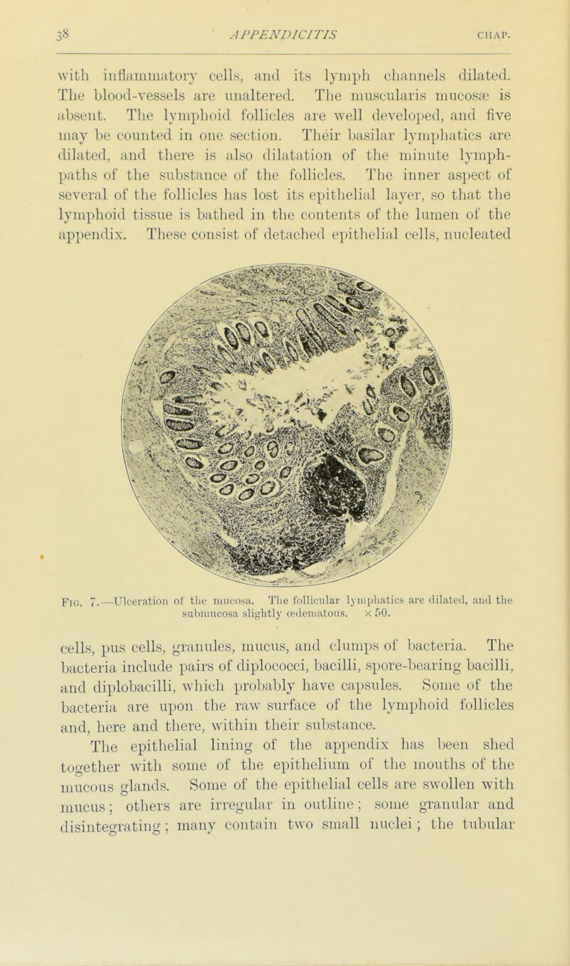 with inflammatory cells, and its lymph channels dilated. The blood-vessels are unaltered. The muscularis mucosae is absent. The Lymphoid follicles are well developed, and five may be ( (muted in one section. Their basilar lymphatics are dilated, and there is also dilatation of the minute lymph- paths of the substance of the follicles. The inner aspect of several of the follicles has lost its epithelial layer, so that the lymphoid tissue is bathed in the contents of the lumen of the appendix. These consist of detached epithelial cells, nucleated |.-],; 7,—Ulceration of tin- mucosa. The follicular lymphatics arc dilated, and the subraucosa slightly (edematous. x 50. cells, pus cells, granules, mucus, and clumps of bacteria. The bacteria include pairs of diplococci, bacilli, spore-bearing bacilli, and diplobacilli, which probably have capsules. Some of the bacteria are upon the raw surface of the lymphoid follicles and, here and there, within their substance. The epithelial lining of the appendix has been shed together with some of the epithelium of the mouths of the mucous glands. Some of the epithelial cells are swollen with mucus ; others are irregular in outline ; some granular and disintegrating; many contain two small nuclei ; the tubular