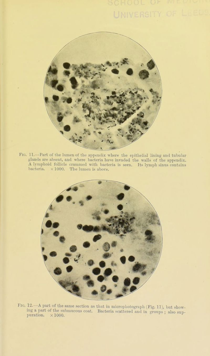 Fu;. 11.—Part of the lumen of the appendix where the epithelial lining and tubular glands are absent, and where bacteria have invaded the walls of the appendix. A lymphoid follicle crammed with bacteria is seen. Its lymph sinus contains bacteria, x 1000. The lumen is above. Fio. 12. A part of the same section as that in microphotograph (Fig. 11), but show- ing a part of the submucous coat. Bacteria scattered and in groups ; also sup- puration, x 1000.