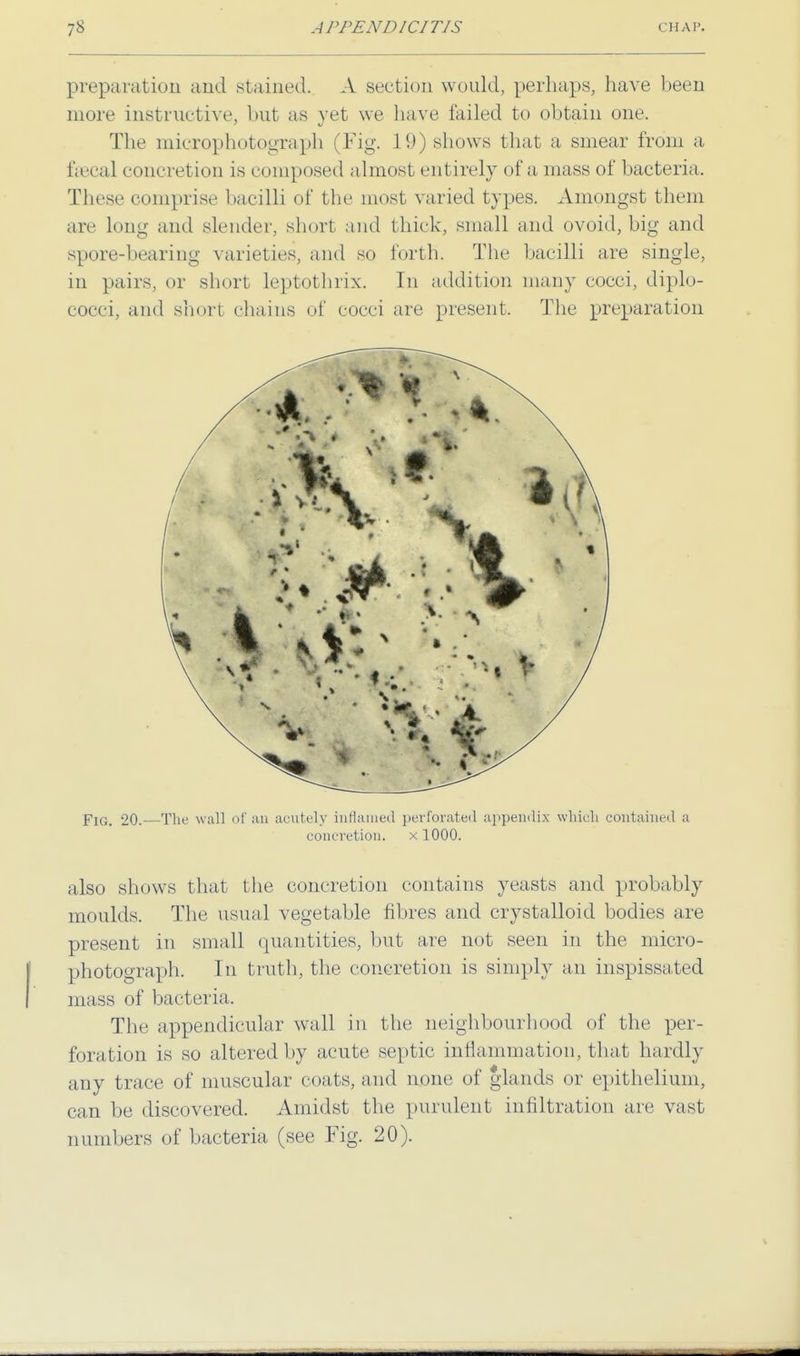 preparation and stained. A section would, perhaps, have been more instructive, but as yet we have failed to obtain one. The microphotograph (Fig. 19) shows that a smear from a fsecal concretion is composed almost entirely of a mass of bacteria. These comprise bacilli of the most varied types. Amongst them are long and slender, short and thick, small and ovoid, big and spore-bearing varieties, and so forth. The bacilli are single, in pairs, or short Leptothrix. In addition many cocci, diplo- cocci, and short chains of cocci are present. The preparation Fig. 20.—The wall of au acutely inflamed perforated appendix which contained a concretion. x 1000. also shows that the concretion contains yeasts and probably moulds. The usual vegetable fibres and crystalloid bodies are present in small quantities, but are not seen in the micro- photograph. In truth, the concretion is simply an inspissated mass of bacteria. The appendicular wall in the neighbourhood of the per- foration is so altered by acute septic inflammation, that hardly any trace of muscular coats, and none of glands or epithelium, can be discovered. Amidst the purulent infiltration are vast numbers of bacteria (see Fig. 20).