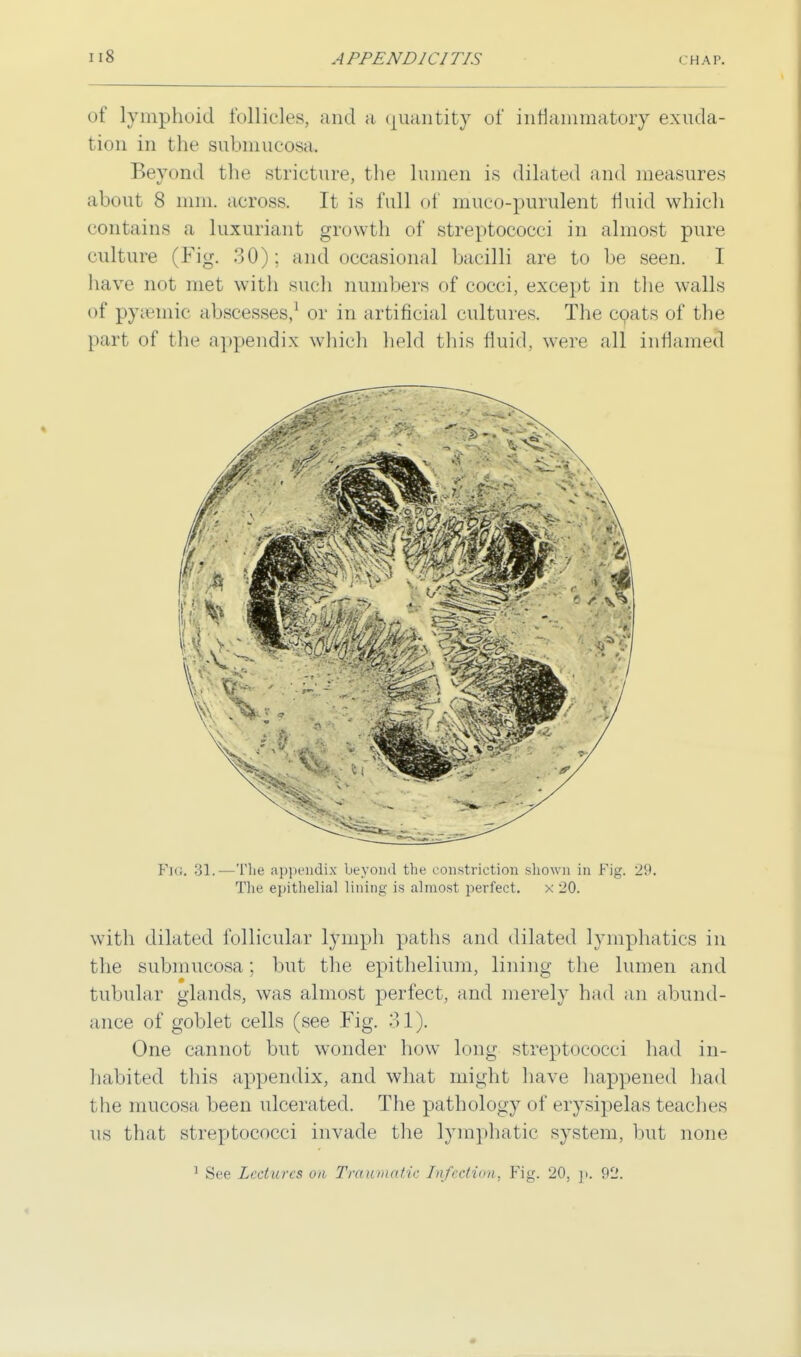 of lymphoid follicles, and a quantity of inflammatory exuda- tion in the submucosa. Beyond the stricture, the lumen is dilated and measures about 8 mm. across. It is full of mueo-purulent fluid which contains a luxuriant growth of streptococci in almost pure culture (Fig. 30); and occasional bacilli are to be seen. I have not met with such numbers of cocci, except in the walls of pysemic abscesses,1 or in artificial cultures. The coats of the part of the appendix which held this fluid, were all inflamed Fig. 31. — The appendix beyond the constriction shown in Pig. 'J'.'. The epithelial lining is almost perfect. x 20. with dilated follicular lymph paths and dilated lymphatics in the submucosa ; but the epithelium, lining the lumen and tubular glands, was almost perfect, and merely had an abund- ance of goblet cells (see Fig. 31). One cannot but wonder how long streptococci had in- habited this appendix, and what might have happened had the mucosa been ulcerated. The pathology of erysipelas teaches us that streptococci invade the lymphatic system, but none 1 See Lectures on Traumatic Infection, Fig. 20, p. 92.