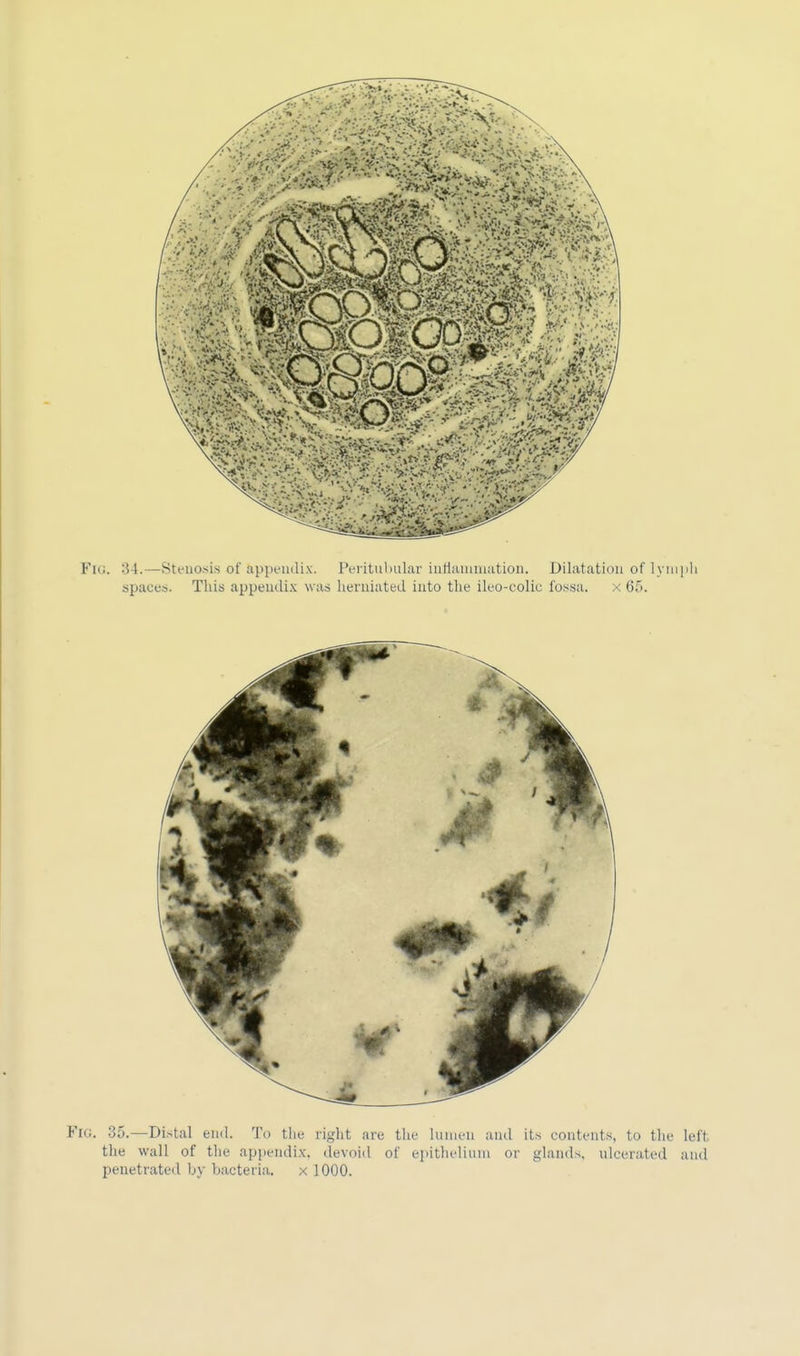 Fig. 35.—Distal end. To the right arc the Lumen and its contents, to the left the wall of the appendix, devoid of epithelium or glands, ulcerated and