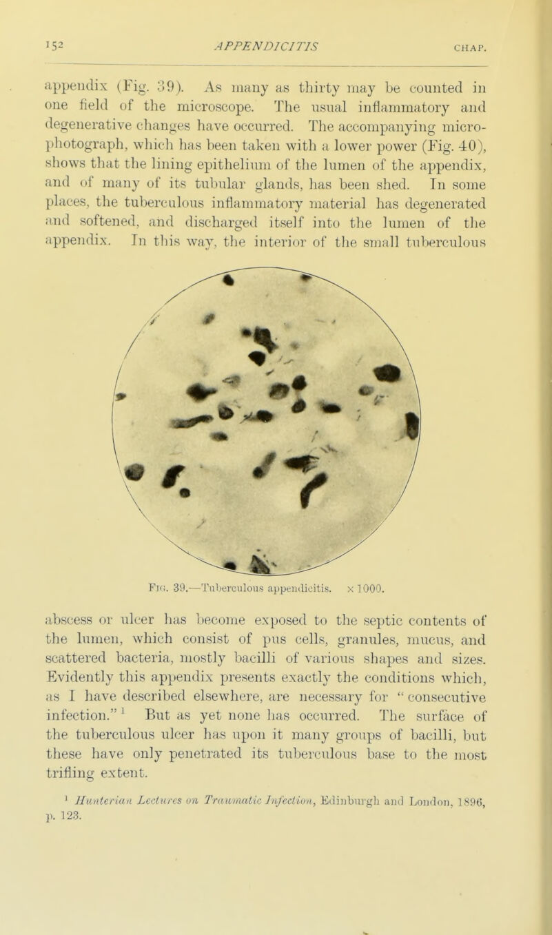 appendix (Fig. 39). As many as thirty may be counted in one field of the microscope. The usual inflammatory and degenerative changes have occurred. The accompanying micro- photograph, which has been taken with a lower power (Fig. 40), shows that the lining epithelium of the lumen of the appendix, and of many of its tubular glands, has been shed. In some places, the tuberculous inflammatory material has degenerated and softened, and discharged itself into the lumen of the appendix. In this way, the interior of the small tuberculous FlG. 39.—Tuberculous appendicitis, x 1000. abscess or ulcer has become exposed to the septic contents of the lumen, which consist of pus cells, granules, mucus, and scattered bacteria, mostly bacilli of various shapes and sizes. Evidently this appendix presents exactly the conditions which, as I have described elsewhere, are necessary for  consecutive infection. 1 But as yet none lias occurred. The surface of the tuberculous ulcer has upon it many groups of bacilli, but these have only penetrated its tuberculous base to the most trifling extent. 1 Hunteriaa Lectures on Traumatic Infection, Edinburgh ami London, 1896, p. 123.