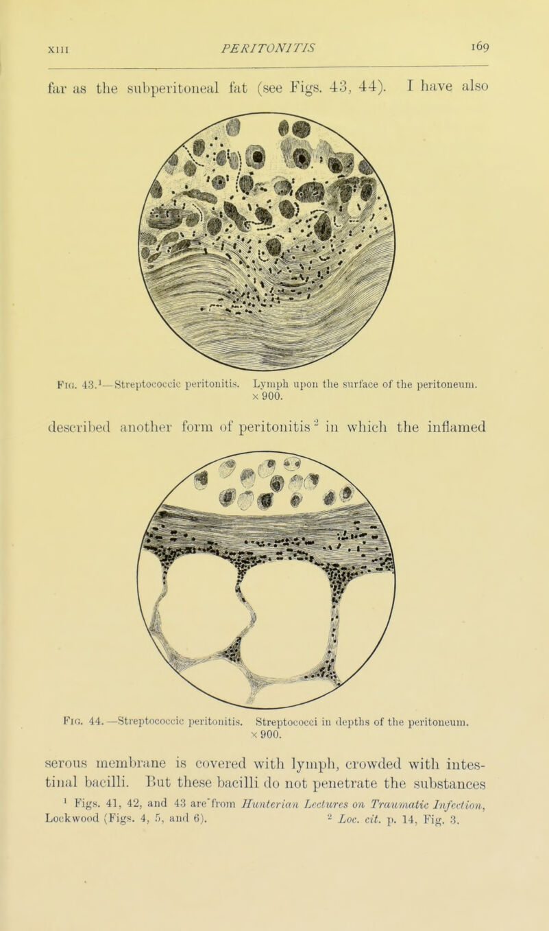 FIG. 43.1—Streptococcic peritonitis. Lymph upon the surface of the peritoneum. x 900. described another form of peritonitis2 in which the inflamed Fig. 44.—Streptococcic peritonitis. Streptococci in depths of the peritoneum. x900. serous membrane is covered with lymph, crowded with intes- tinal bacilli. But these bacilli do not penetrate the substances 1 Figs. 41, 42, and 43 an-'from Hunterian Lectures on Traumatic Infection,